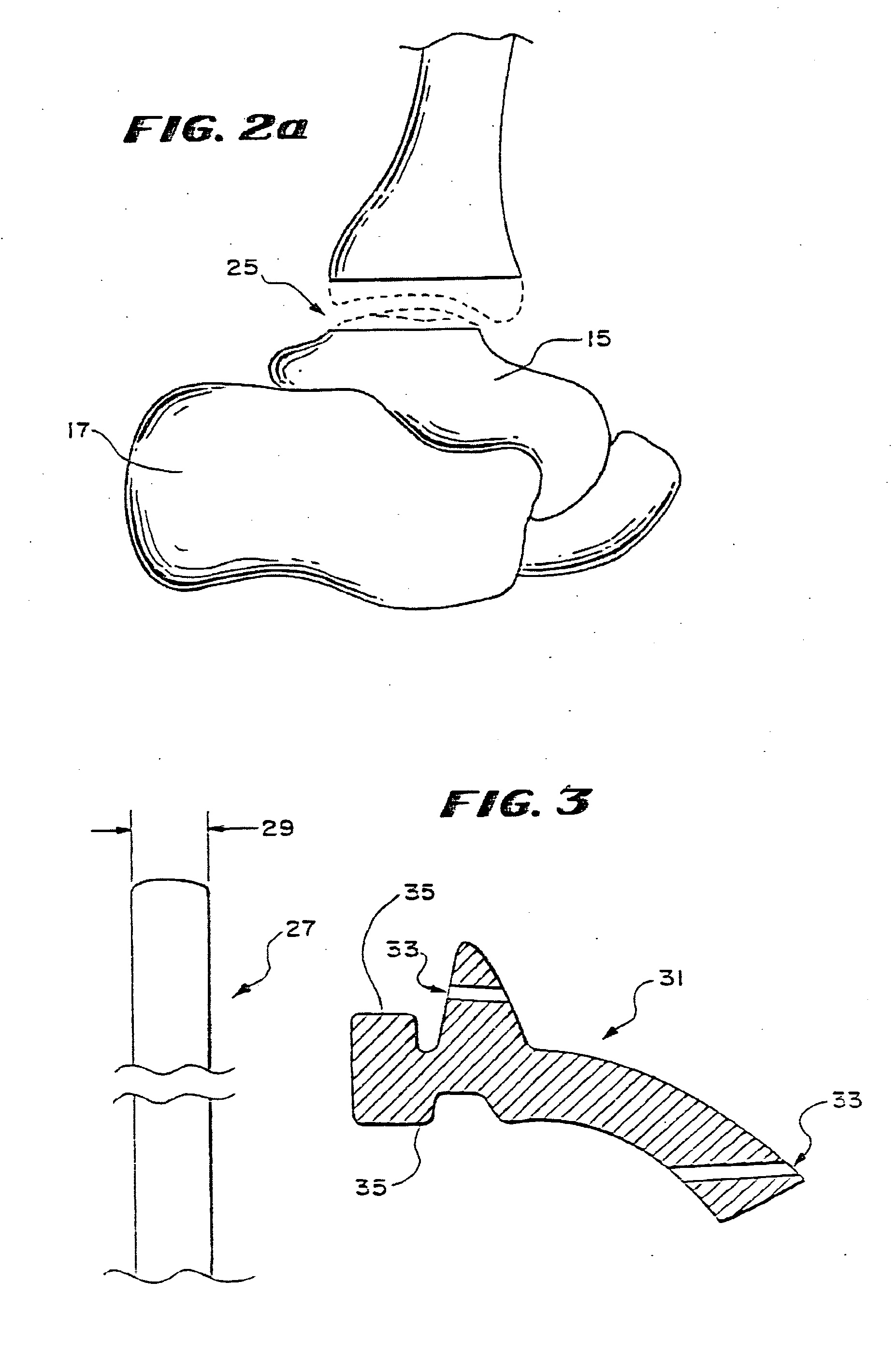 Systems and Methods for Installing Ankle Replacement Prostheses