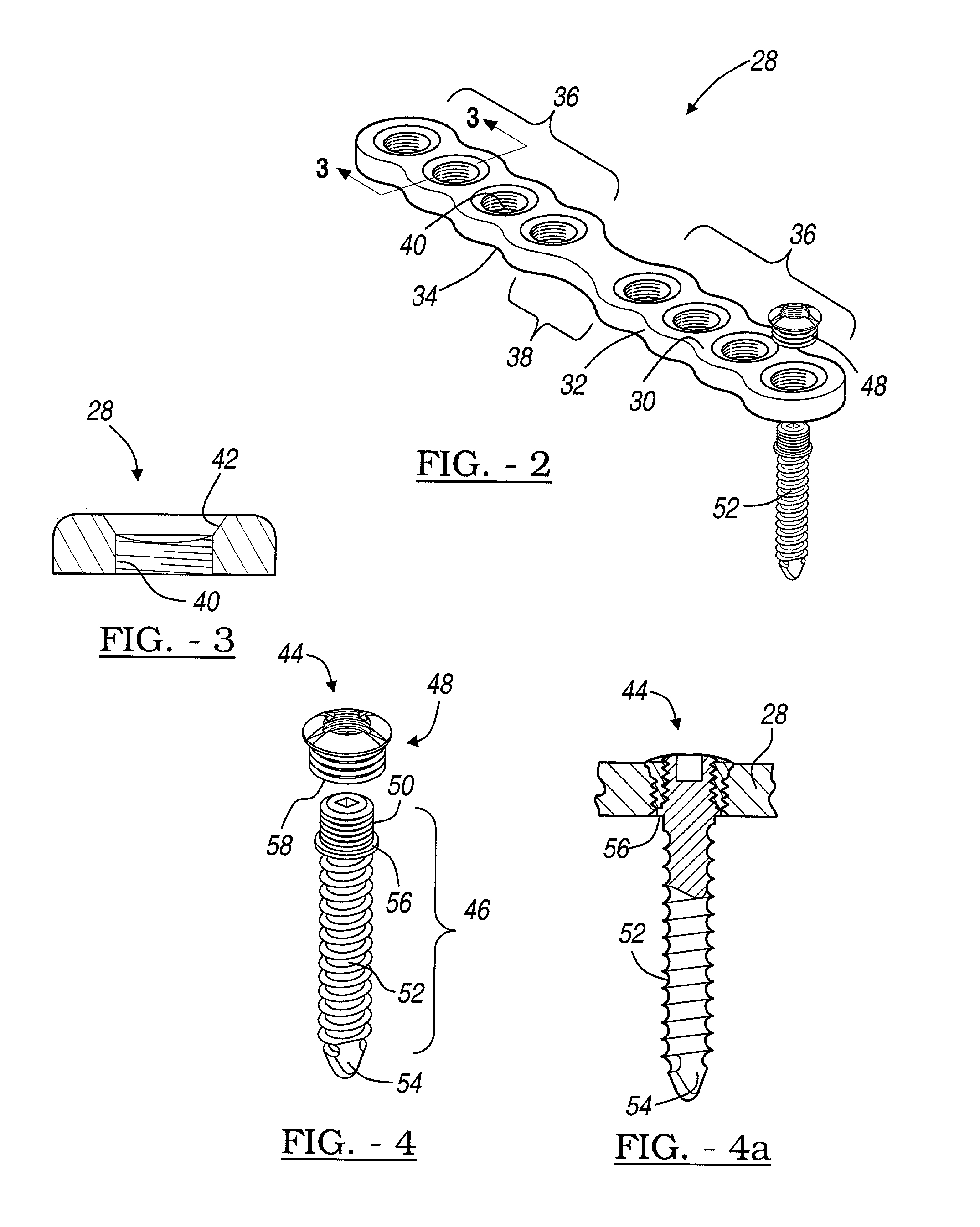 Method and apparatus for bone fracture fixation