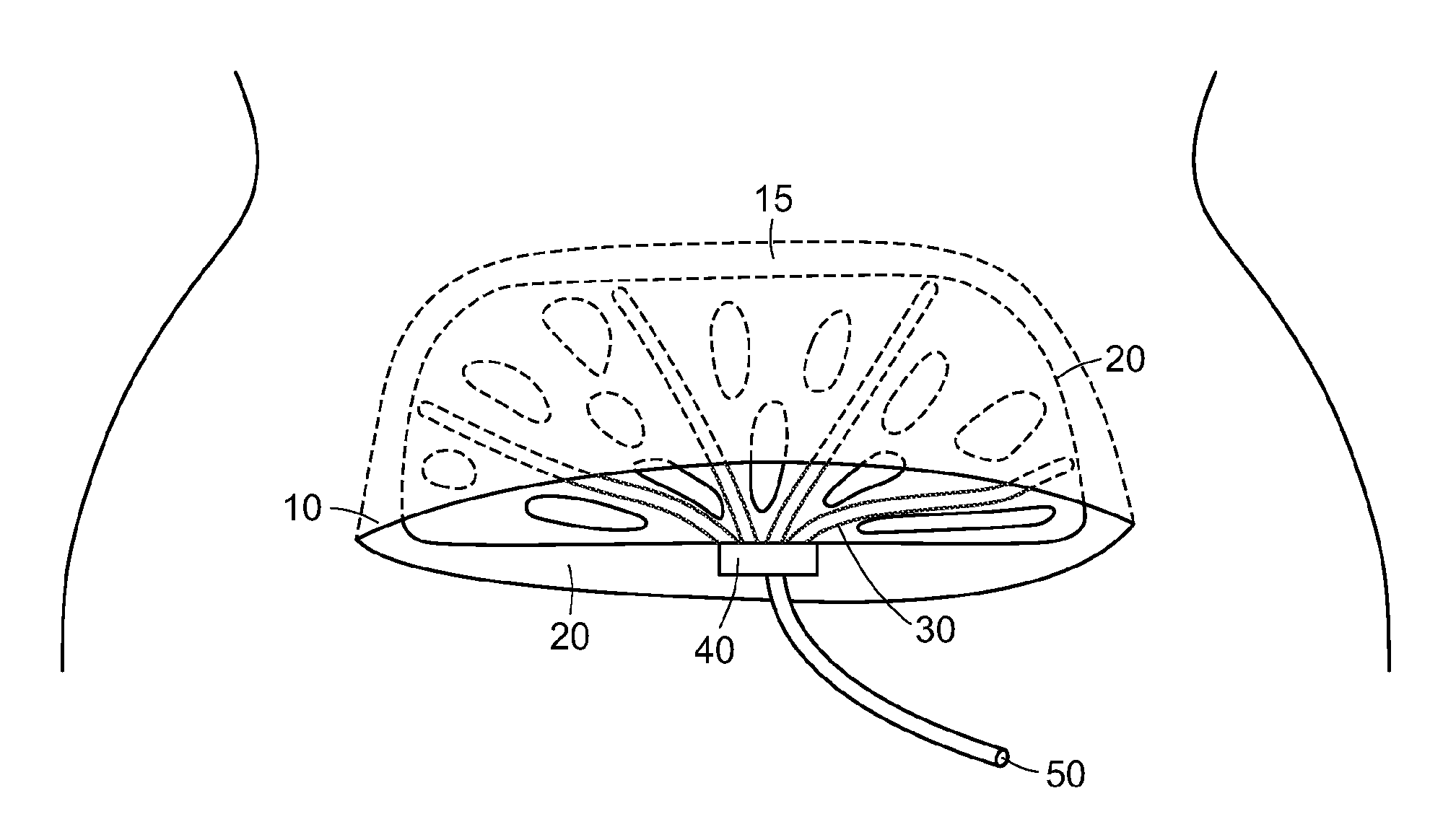 Surgical cavity drainage and closure system
