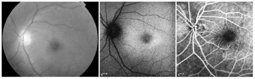 A pathogenic mutation of hereditary central halo retinopathy and its detection reagent