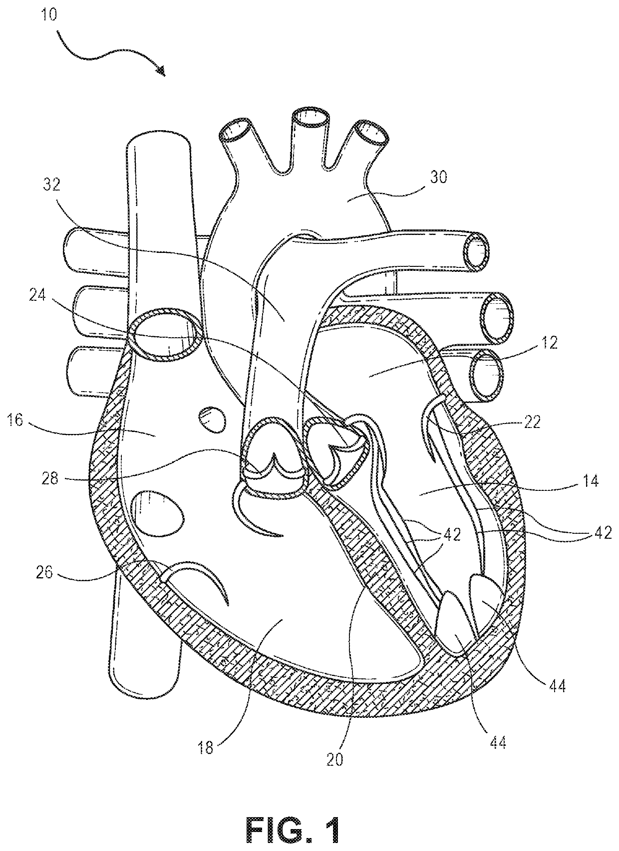 Beating-heart mitral valve chordae replacement