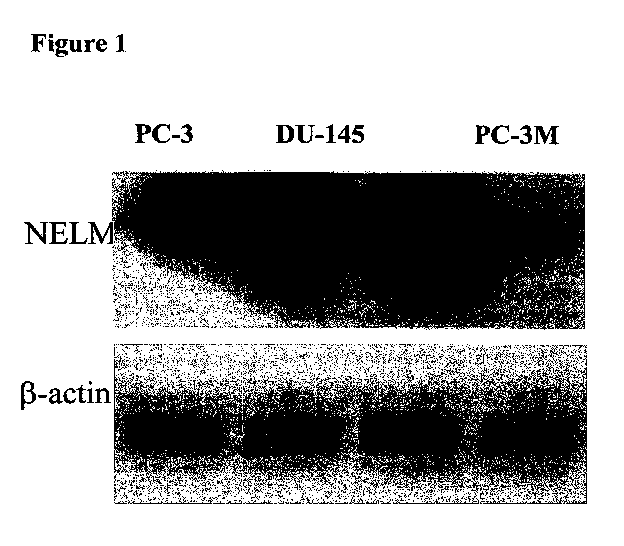 Human cancer cell specific gene transcript