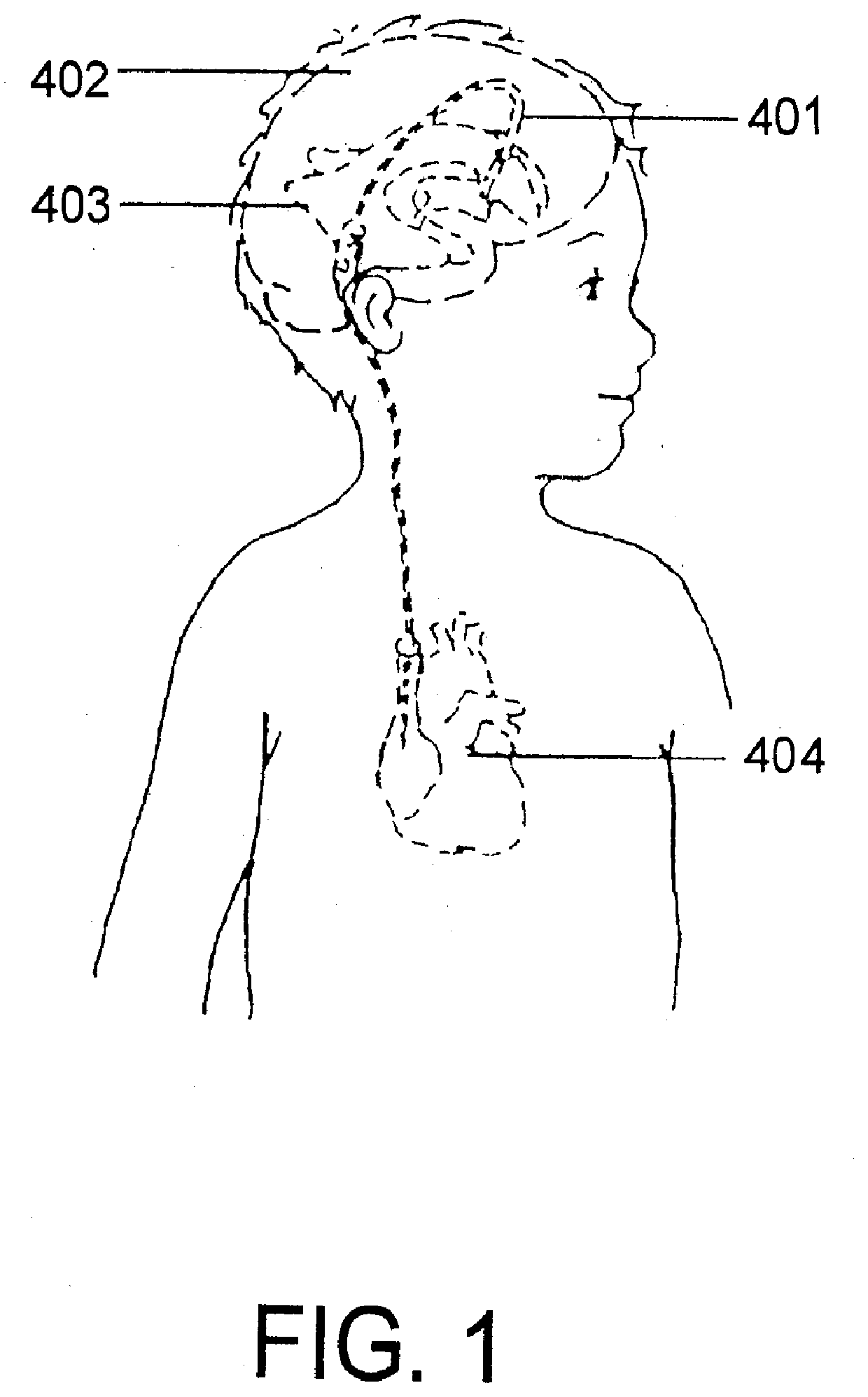 Hydrocephalus shunt arrangement and components thereof for draining cerebrospinal fluid in a patient having hydrocephalus