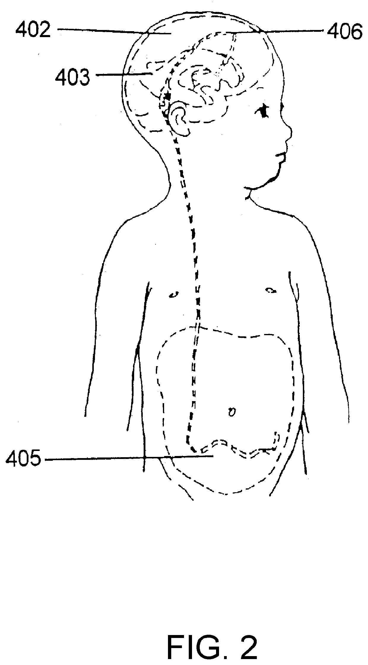 Hydrocephalus shunt arrangement and components thereof for draining cerebrospinal fluid in a patient having hydrocephalus