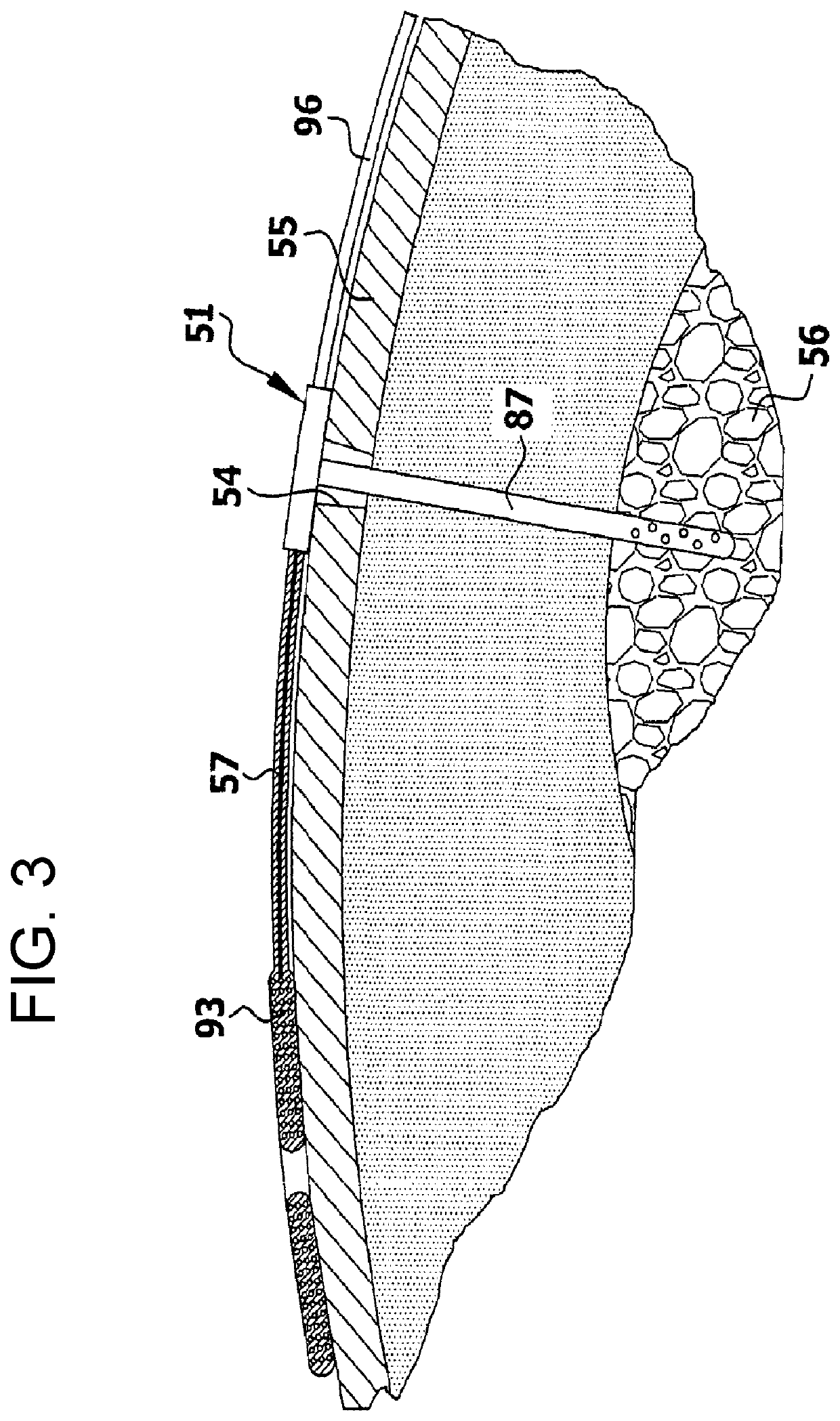 Hydrocephalus shunt arrangement and components thereof for draining cerebrospinal fluid in a patient having hydrocephalus