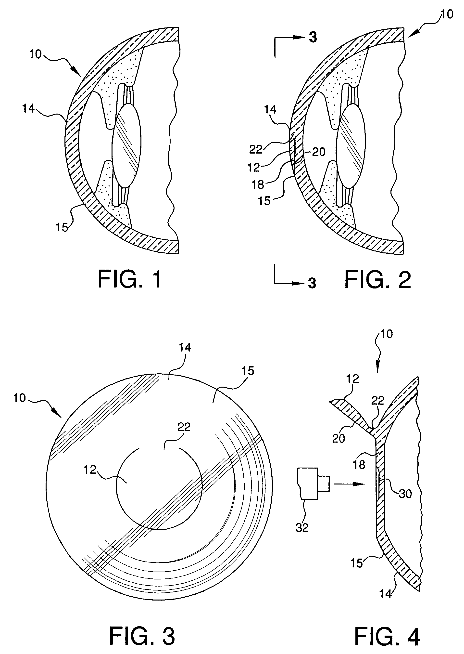 Method for producing a multifocal corneal surface using intracorneal microscopic lenses