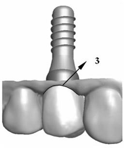Implant denture individual abutment design method based on healing abutment dental model