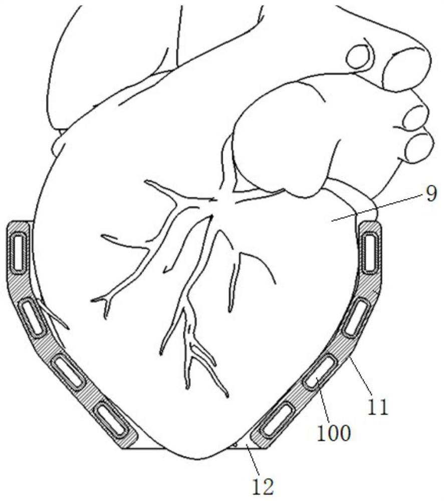 Flexible ventricular assist device