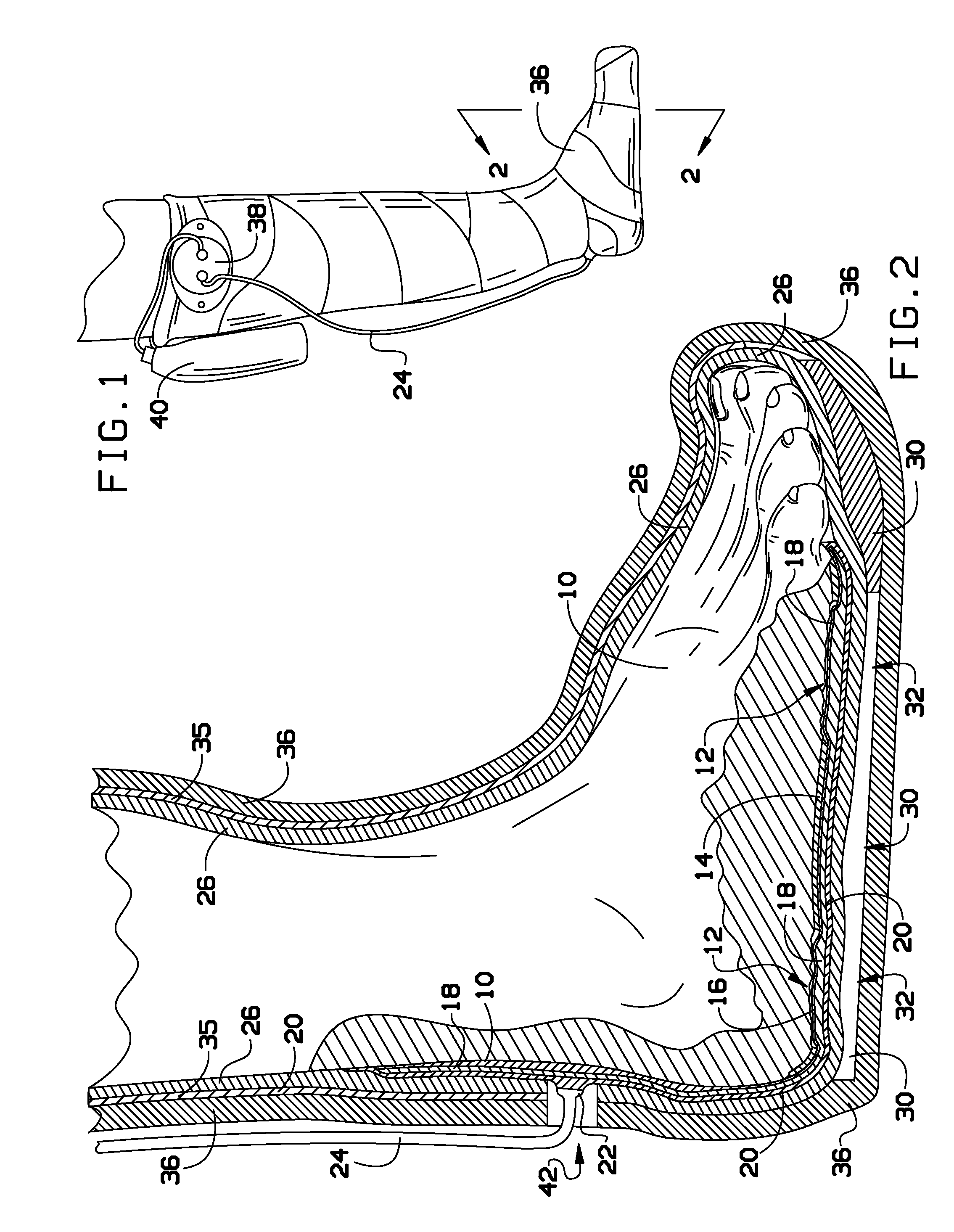 Vacuum cast ("vac-cast") and methods for treatment of plantar wounds