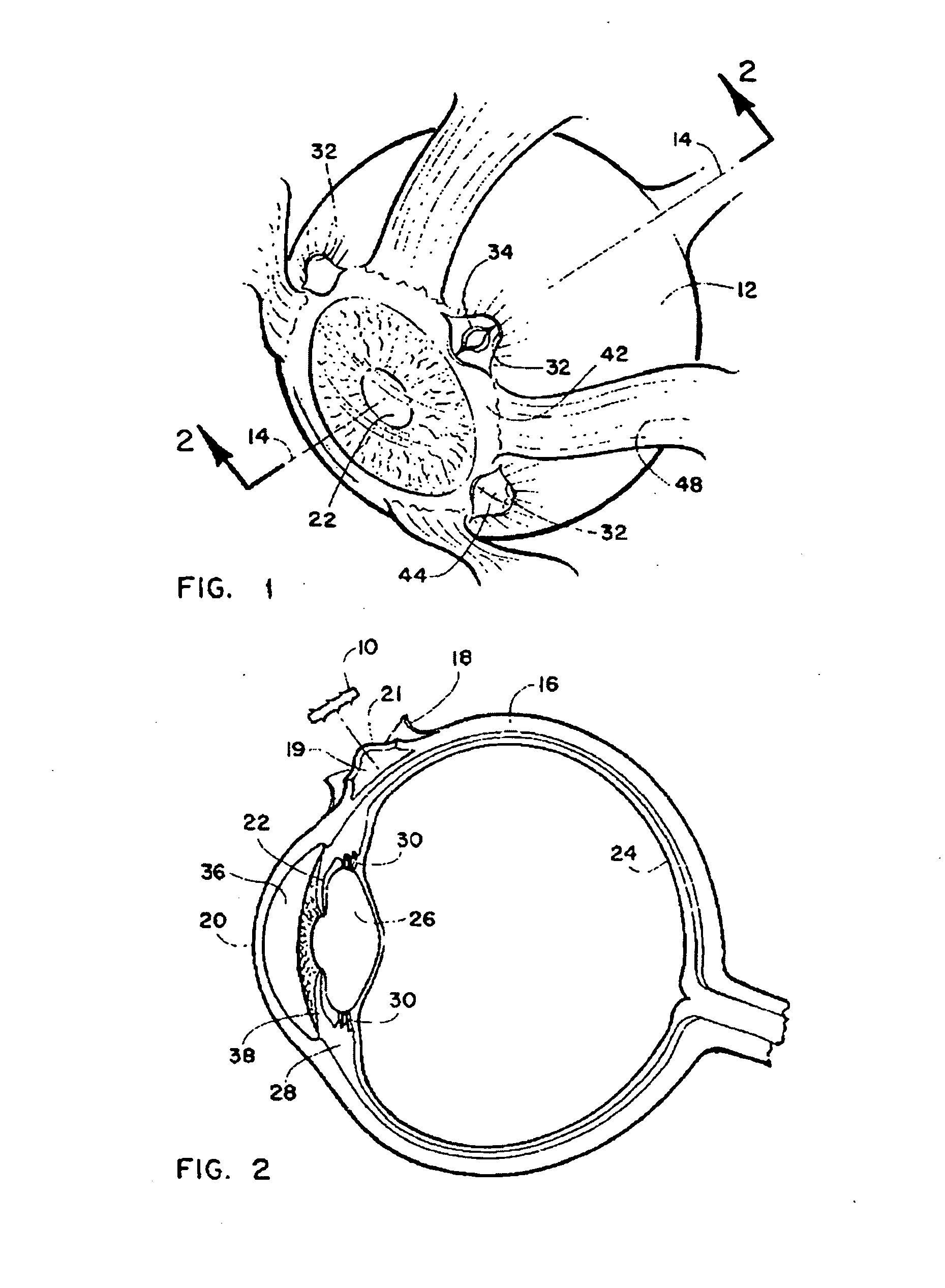 Method and intra-sclera implant for treatment of glaucoma and presbyopia