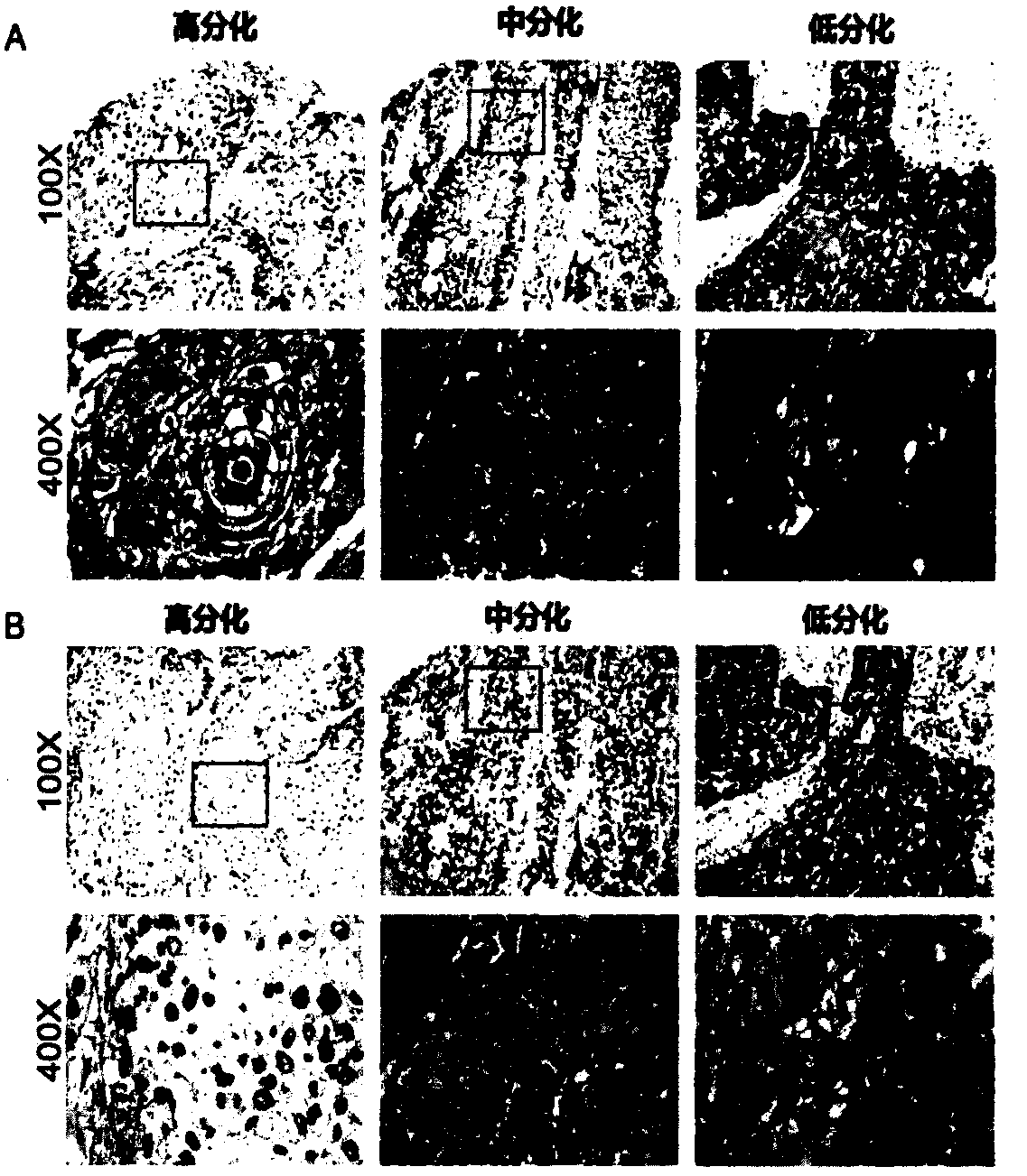 Application of NFI transcription factors in esophageal squamous cell carcinoma