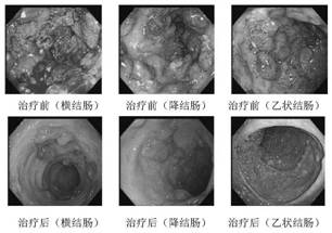 A traditional Chinese medicine composition for rapidly alleviating inflammatory activity of ulcerative colitis and its application