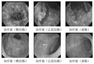 A traditional Chinese medicine composition for rapidly alleviating inflammatory activity of ulcerative colitis and its application