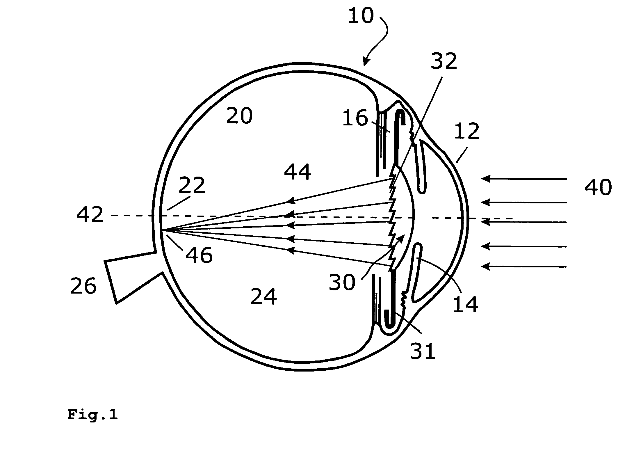Intraocular lens device for the improvement of vision in case of retinal diseases