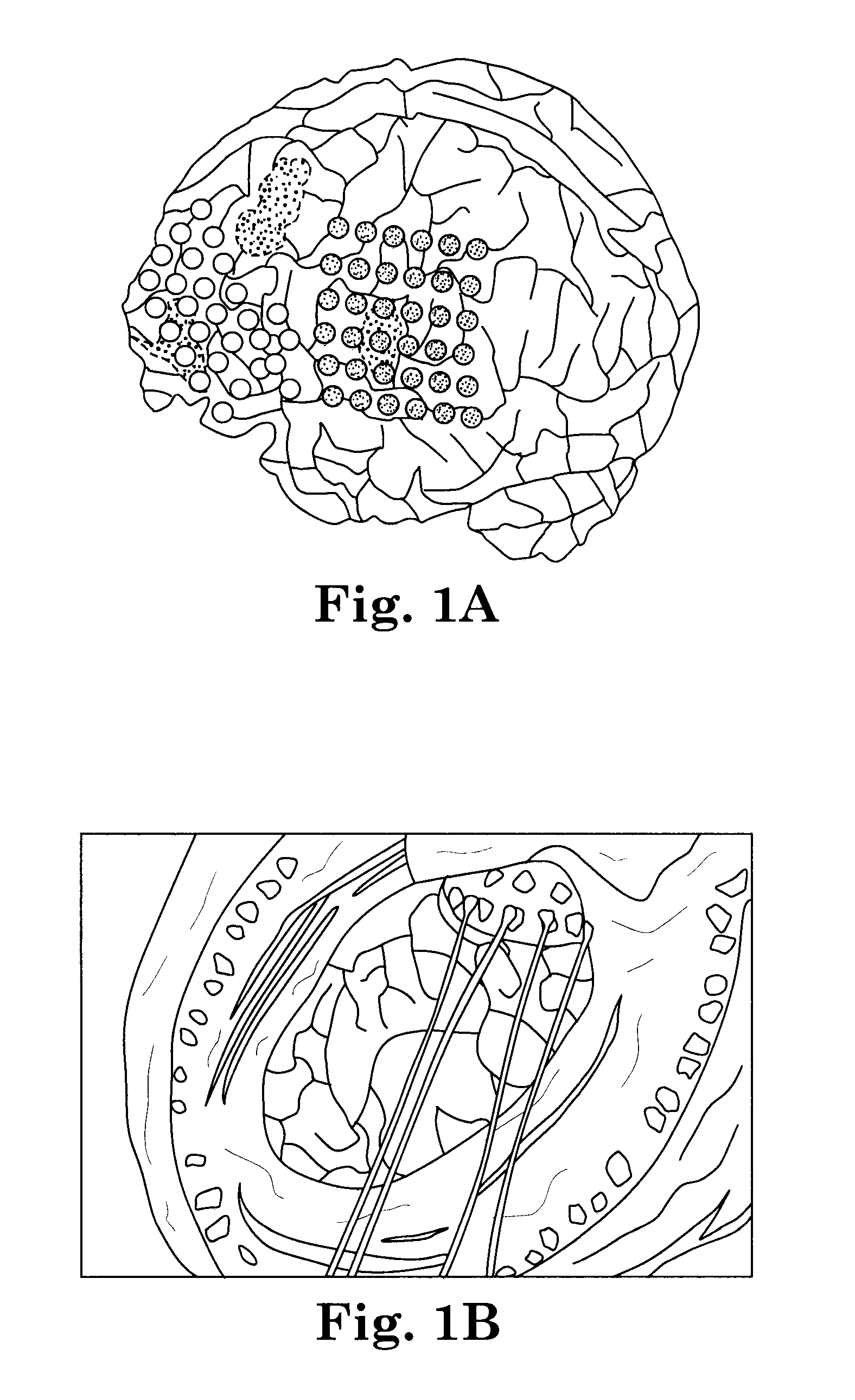 Seizure forecasting, microseizure precursor events, and related therapeutic methods and devices