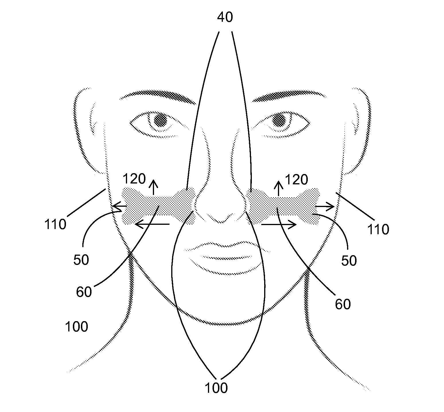 External nasal dilator and method of use