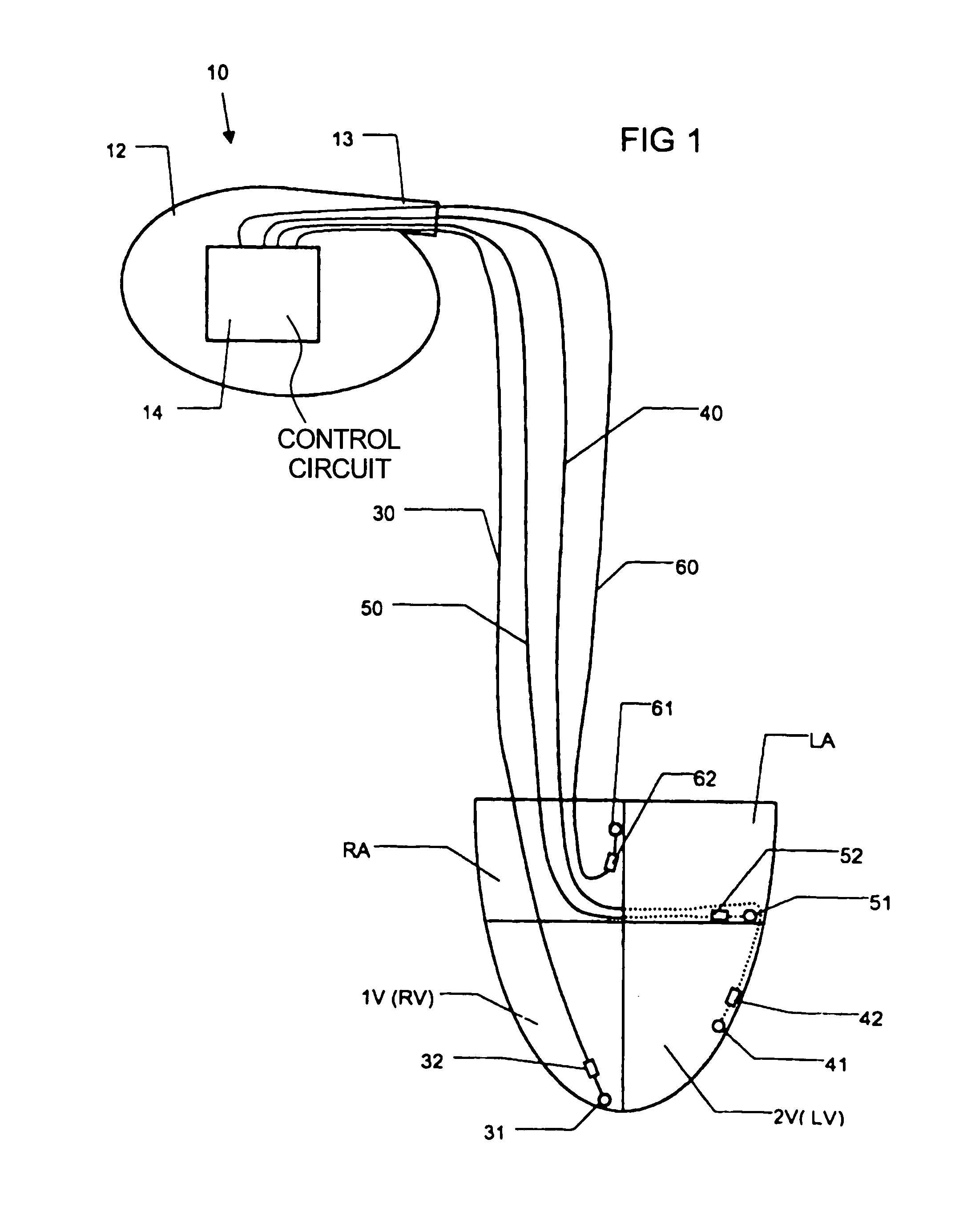 Implantable heart stimulating device, system and method