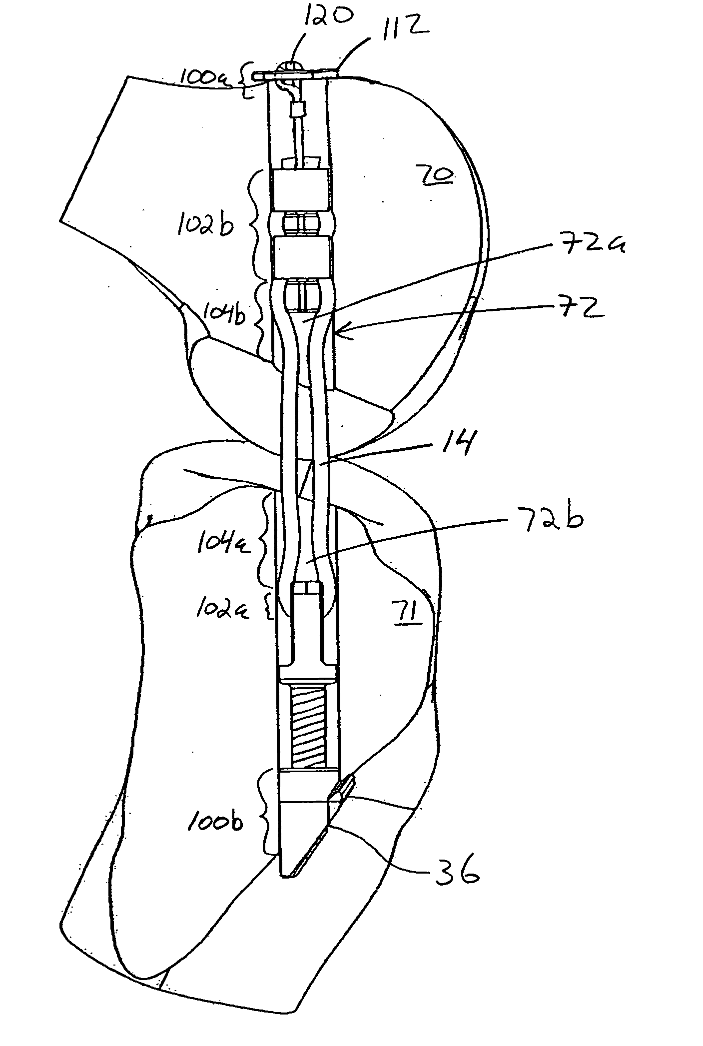 Apparatus for assembling anterior cruciate ligament reconstruction system