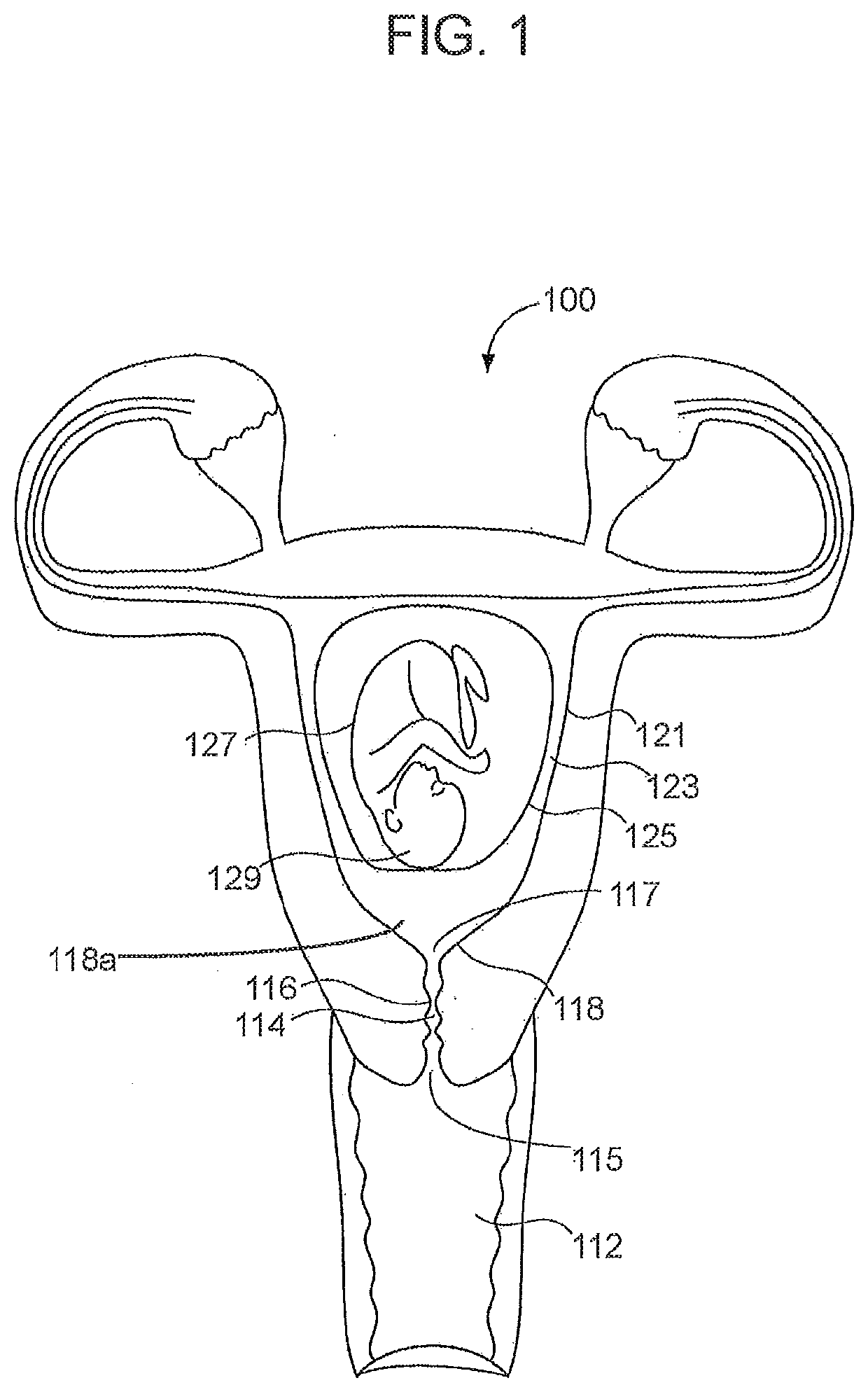 Integrated pressure and fetal heart rate monitoring cervical ripening catheter