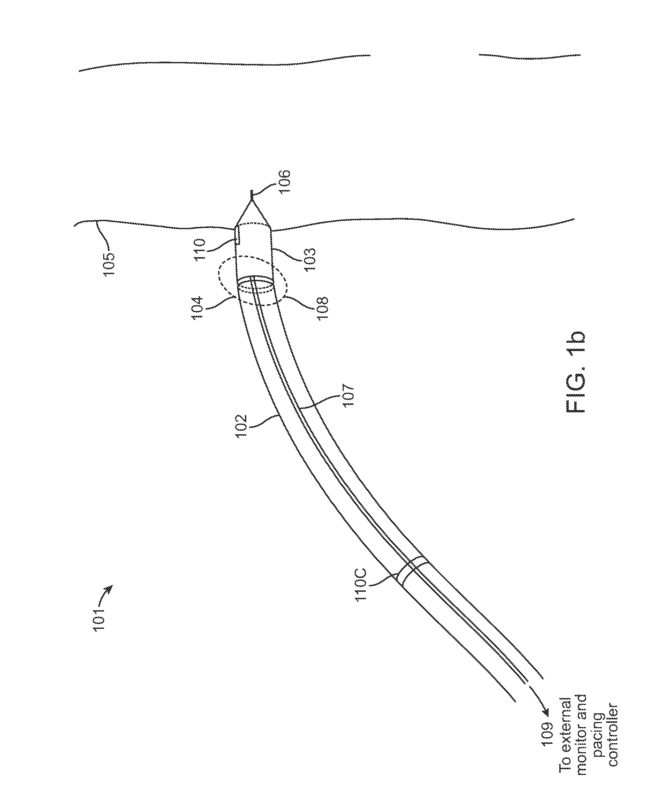 Temporary electrode connection for wireless pacing systems