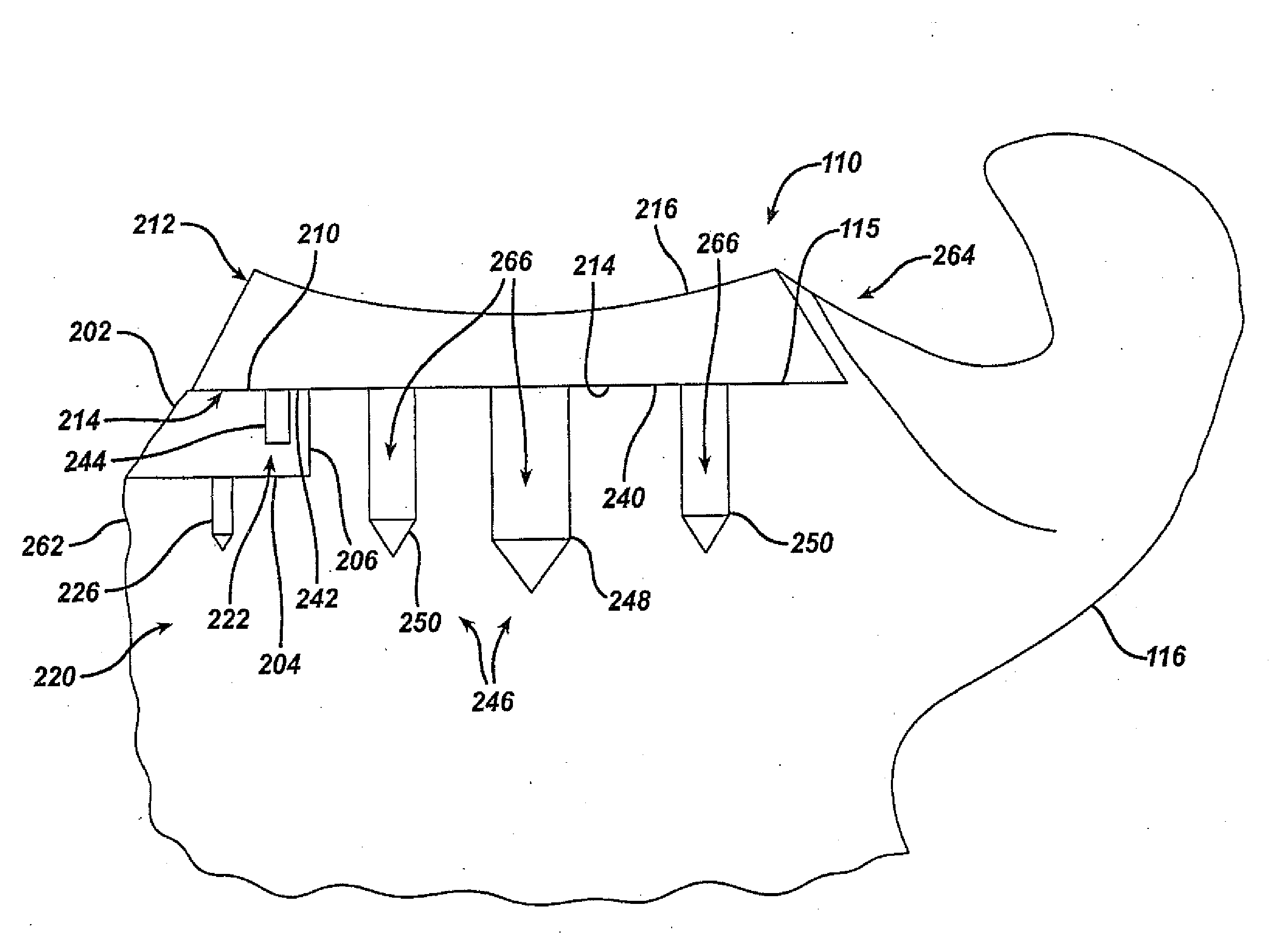 Glenoid augment and associated method