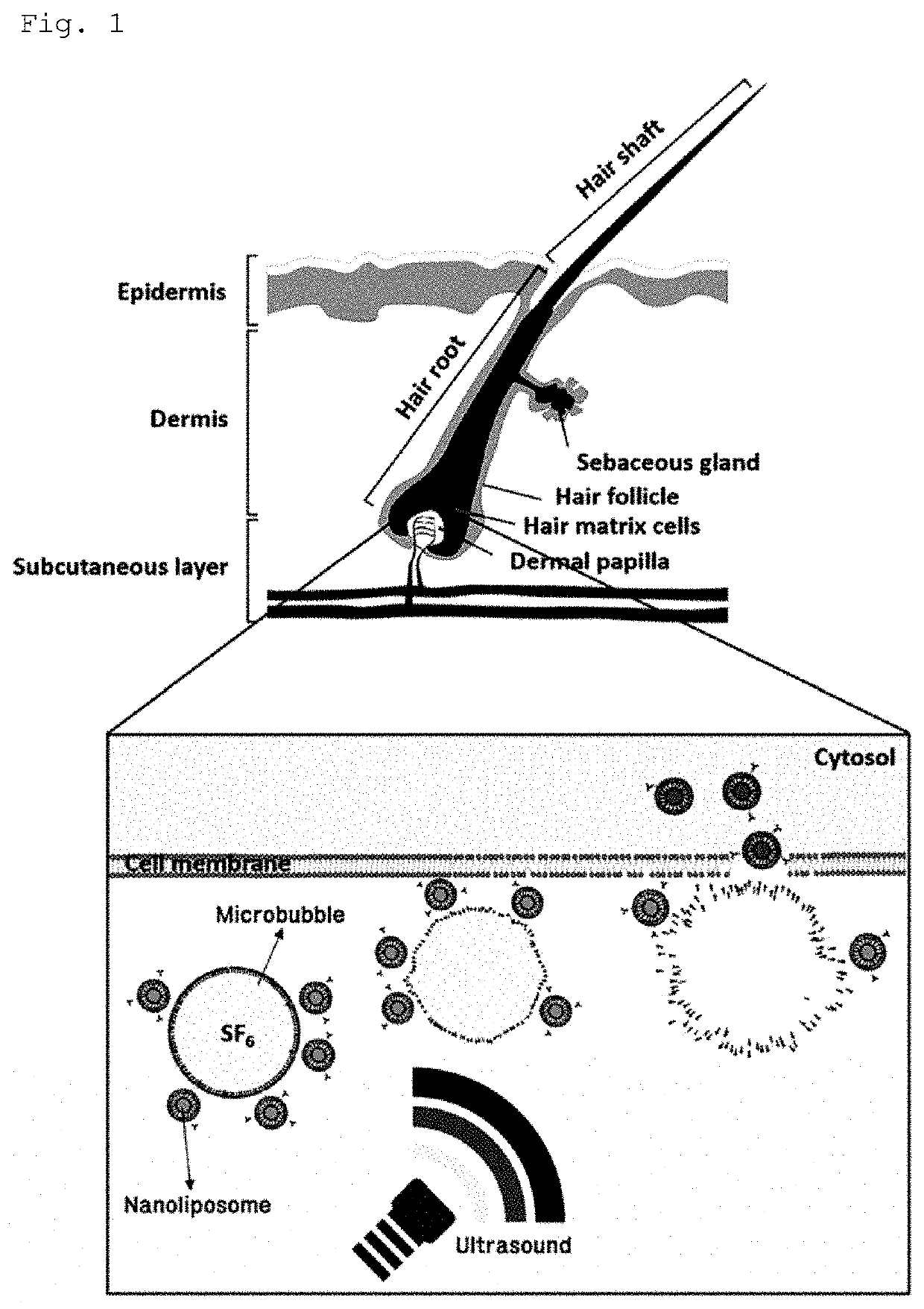 Nanoliposome-microbubble conjugate having complex of cas9 protein, guide RNA inhibiting srd5a2 gene expression and cationic polymer encapsulated in nanoliposome and composition for ameliorating or treating hair loss containing the same