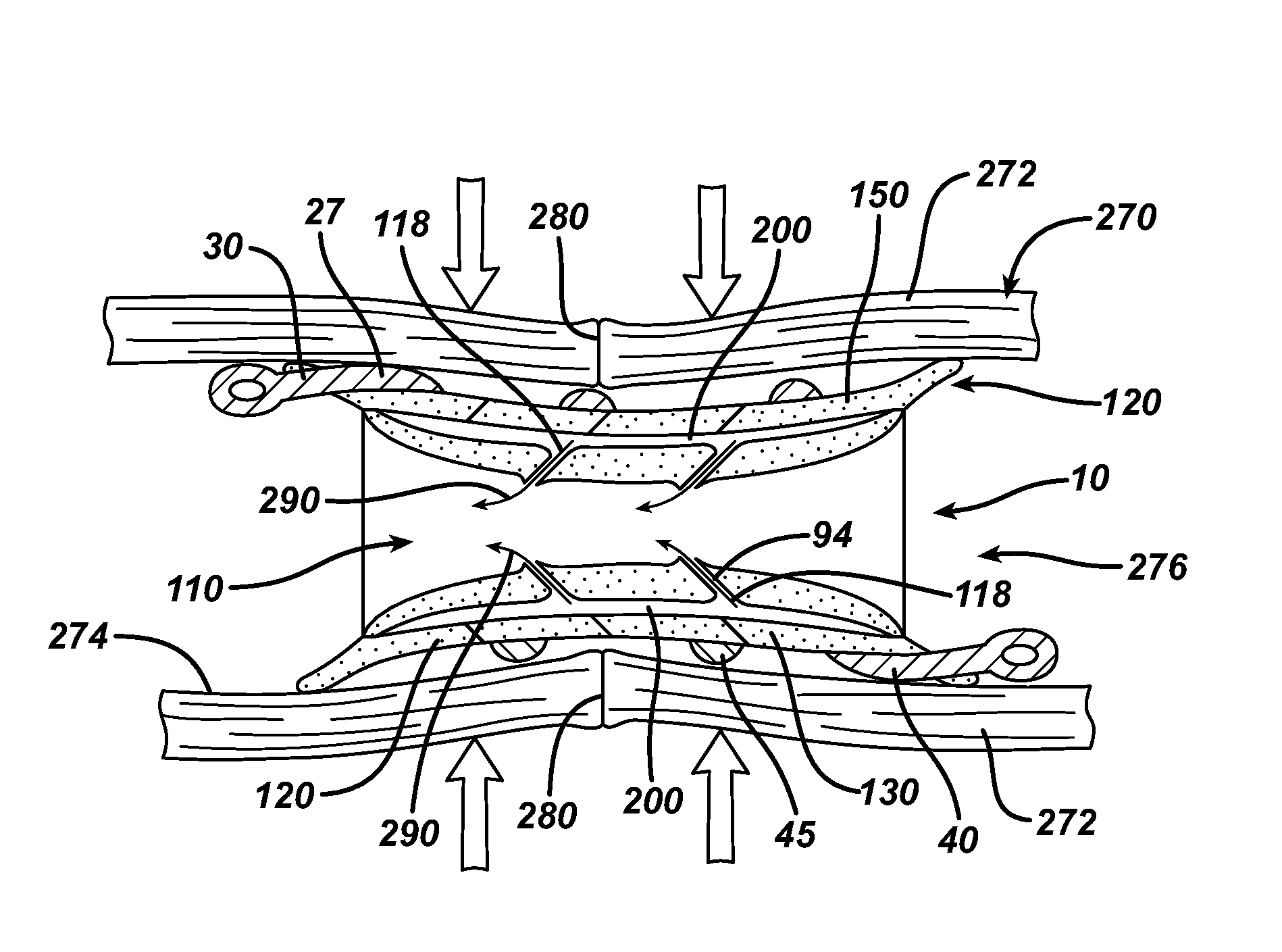 Negative pressure intestinal anastomosis protection devices