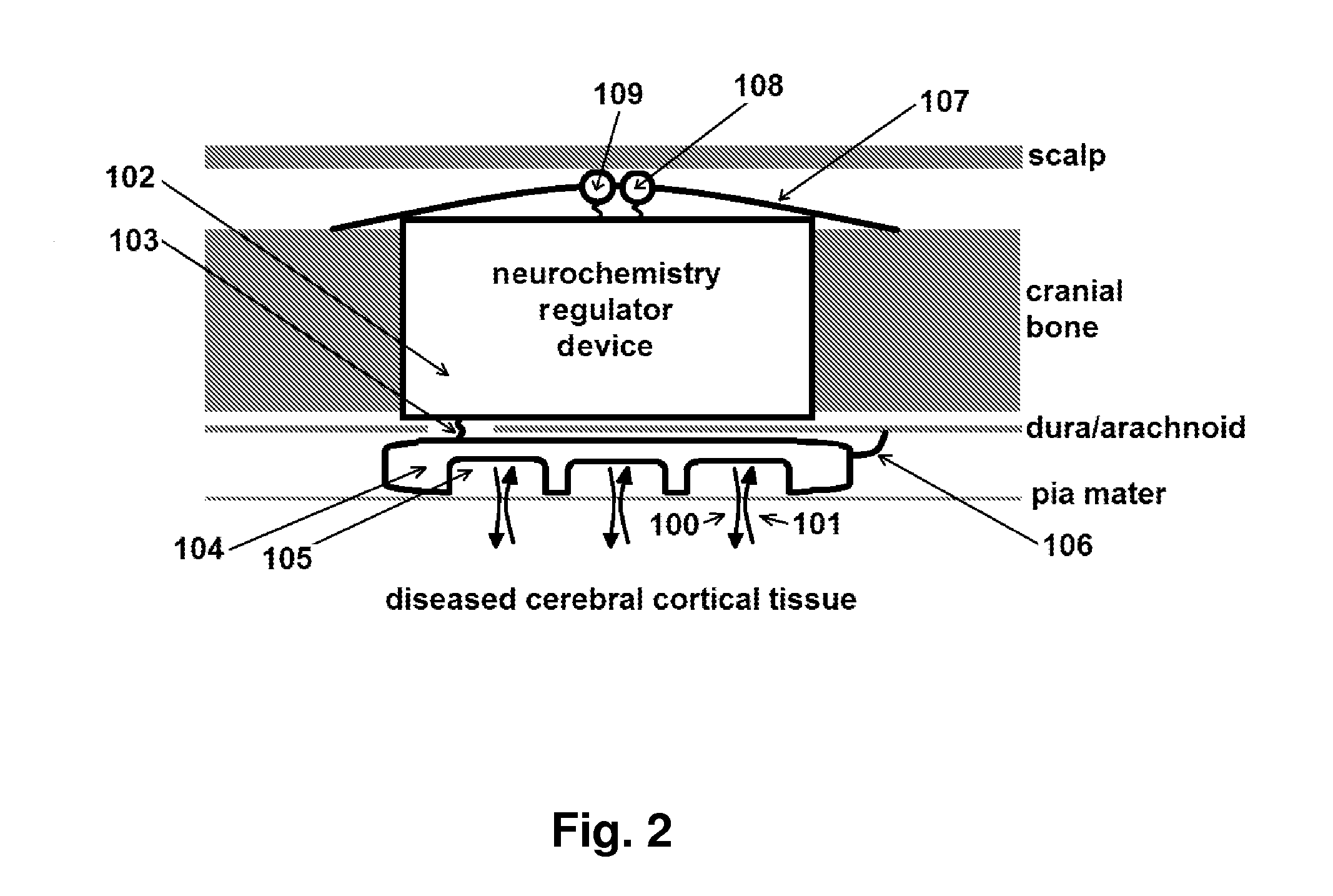 Apparatus and use of a neurochemisrty regulator device insertable in the cranium for the
treatment of cerebral cortical disorders