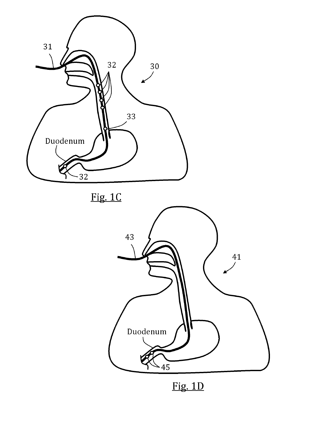 GI tract stimulation devices and methods