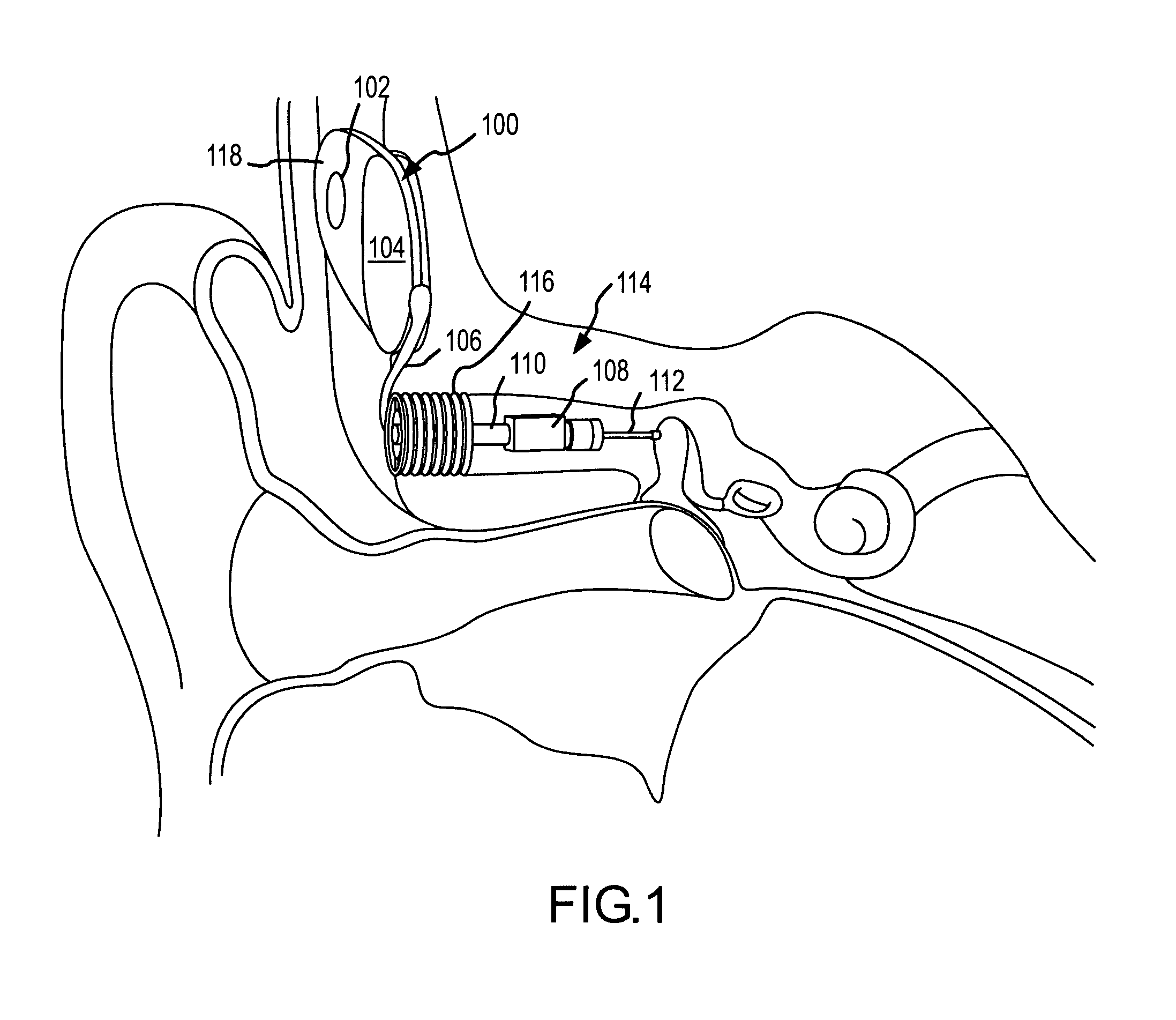 Electrophysiological measurement method and system for positioning an implantable, hearing instrument transducer