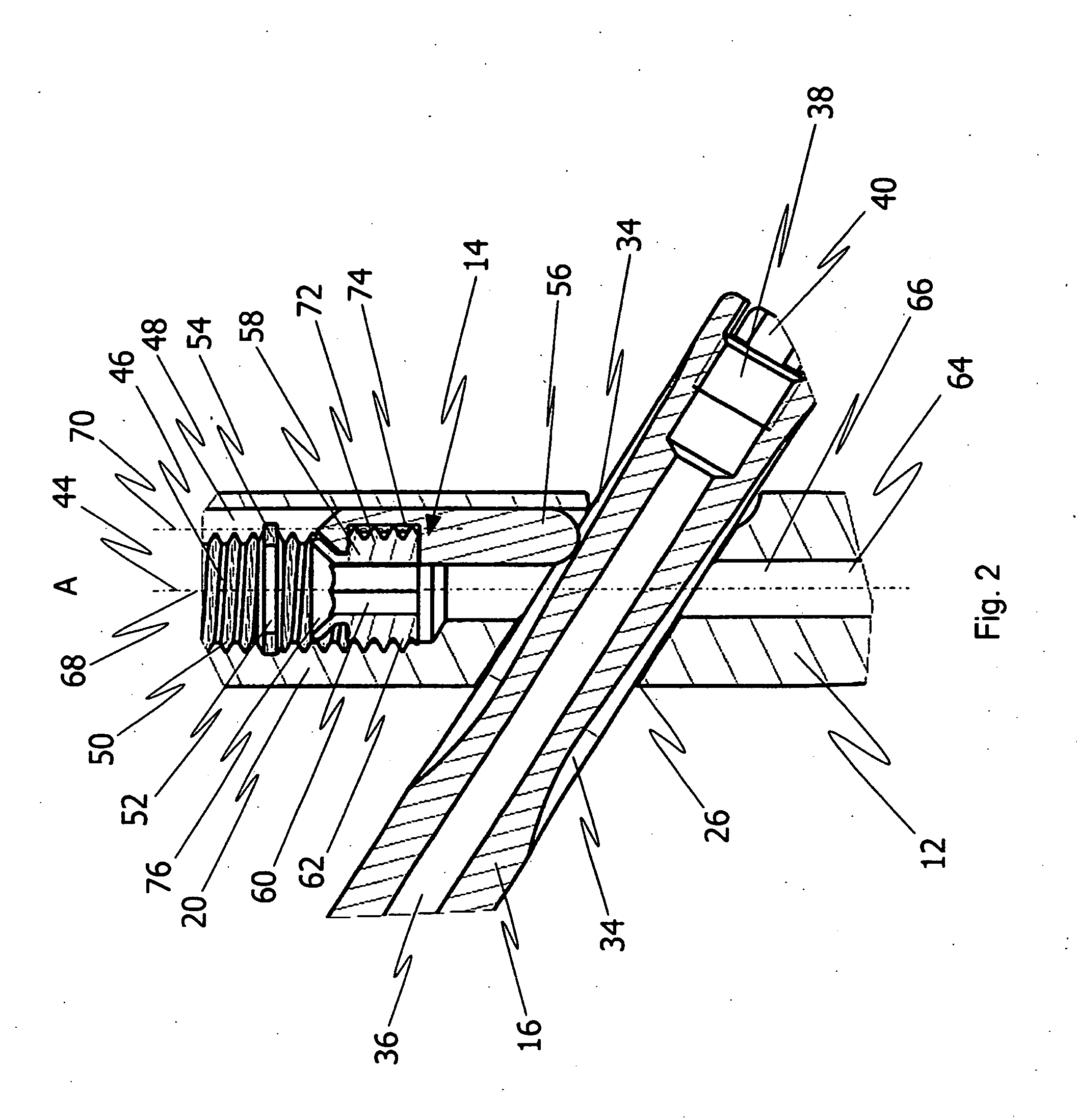 Implant system for bone fixation