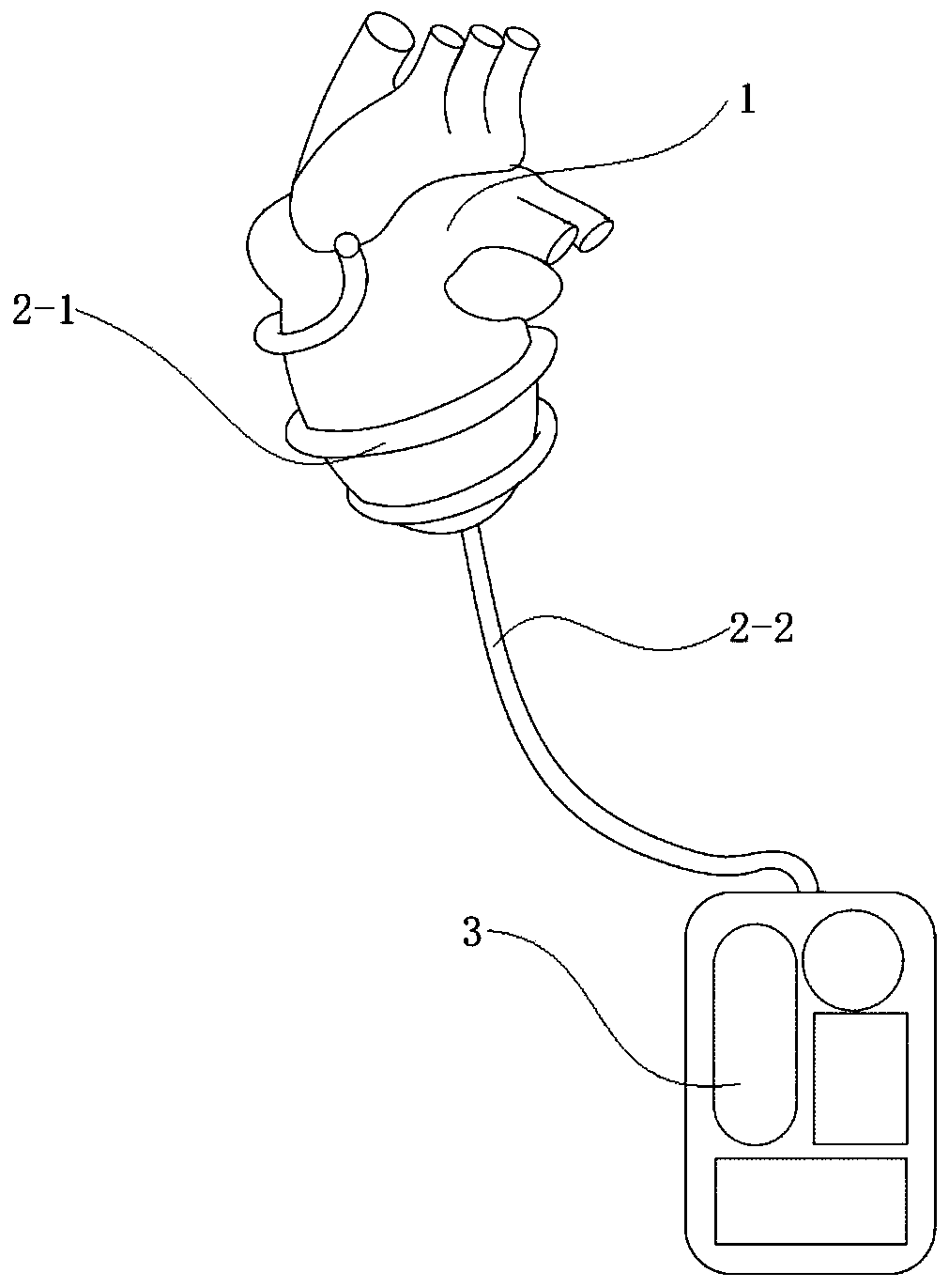 Heart auxiliary stent balloon system, production method thereof and heart assisting device