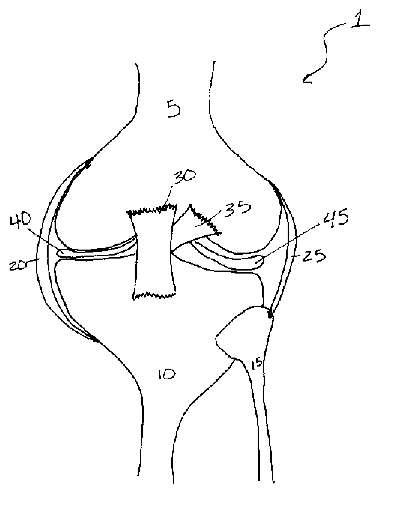 Methods of treating a trauma or disorder of the knee joint by local administration and sustained-delivery of a biological agent