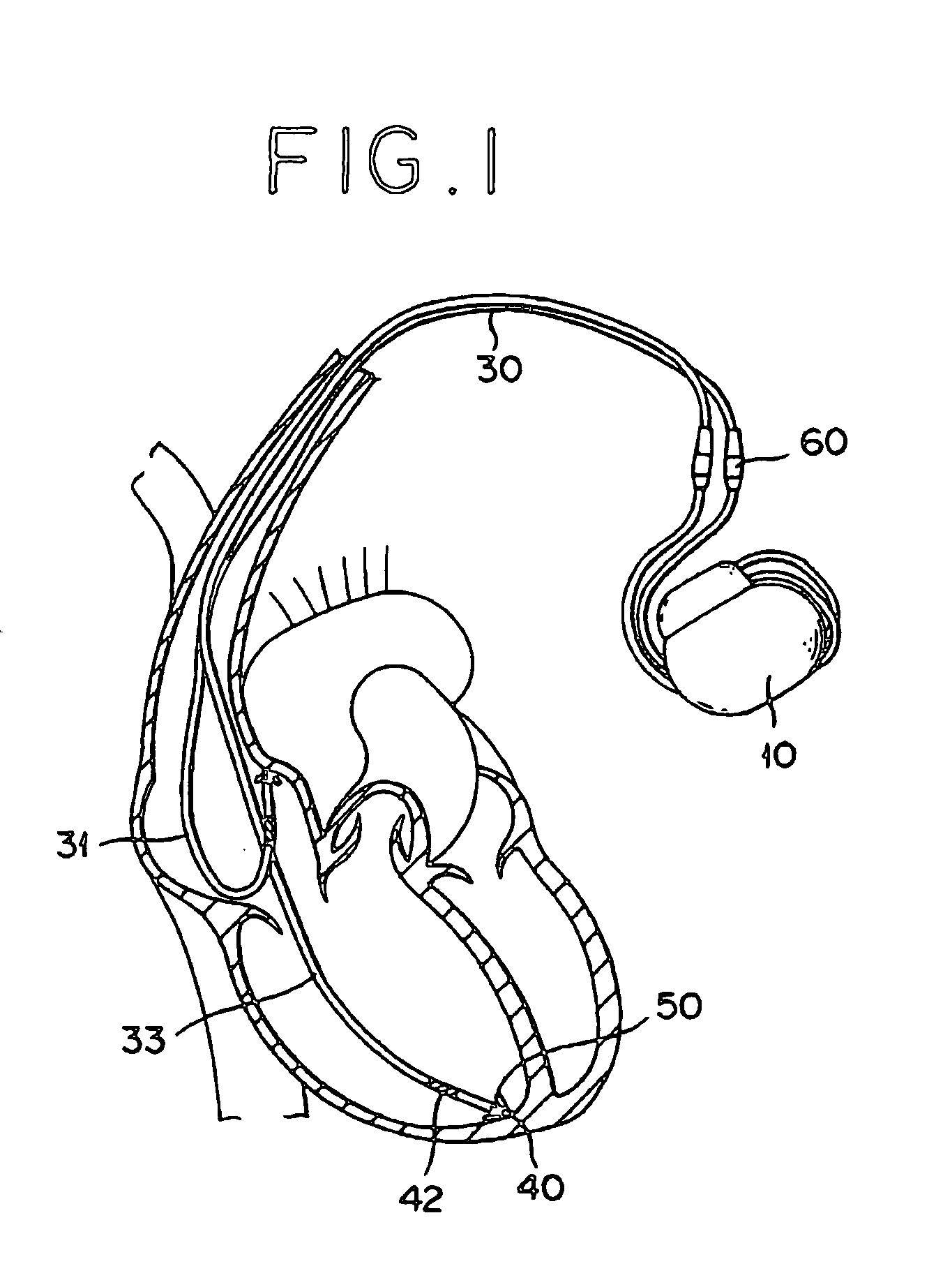 Implantable electrode lead