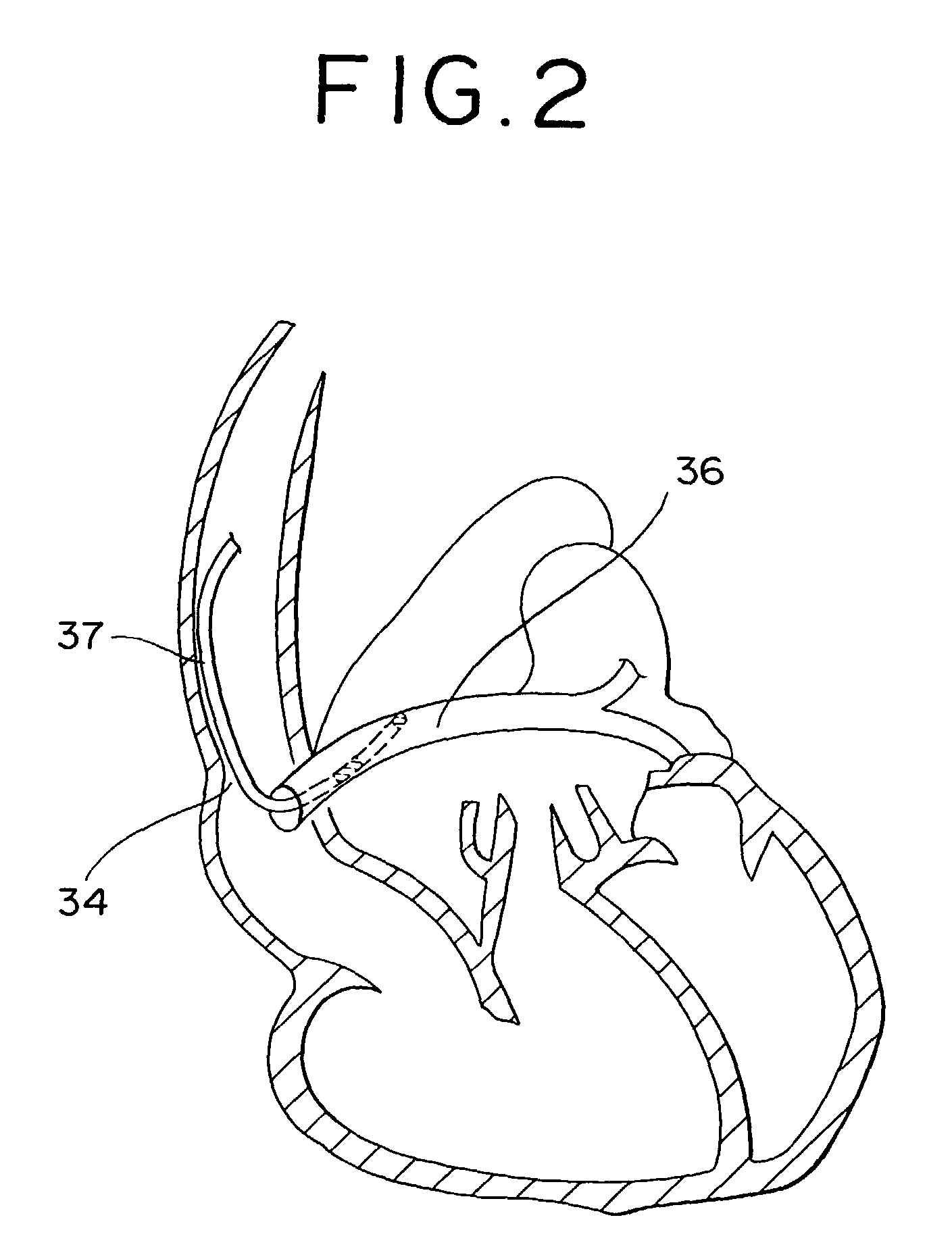 Implantable electrode lead