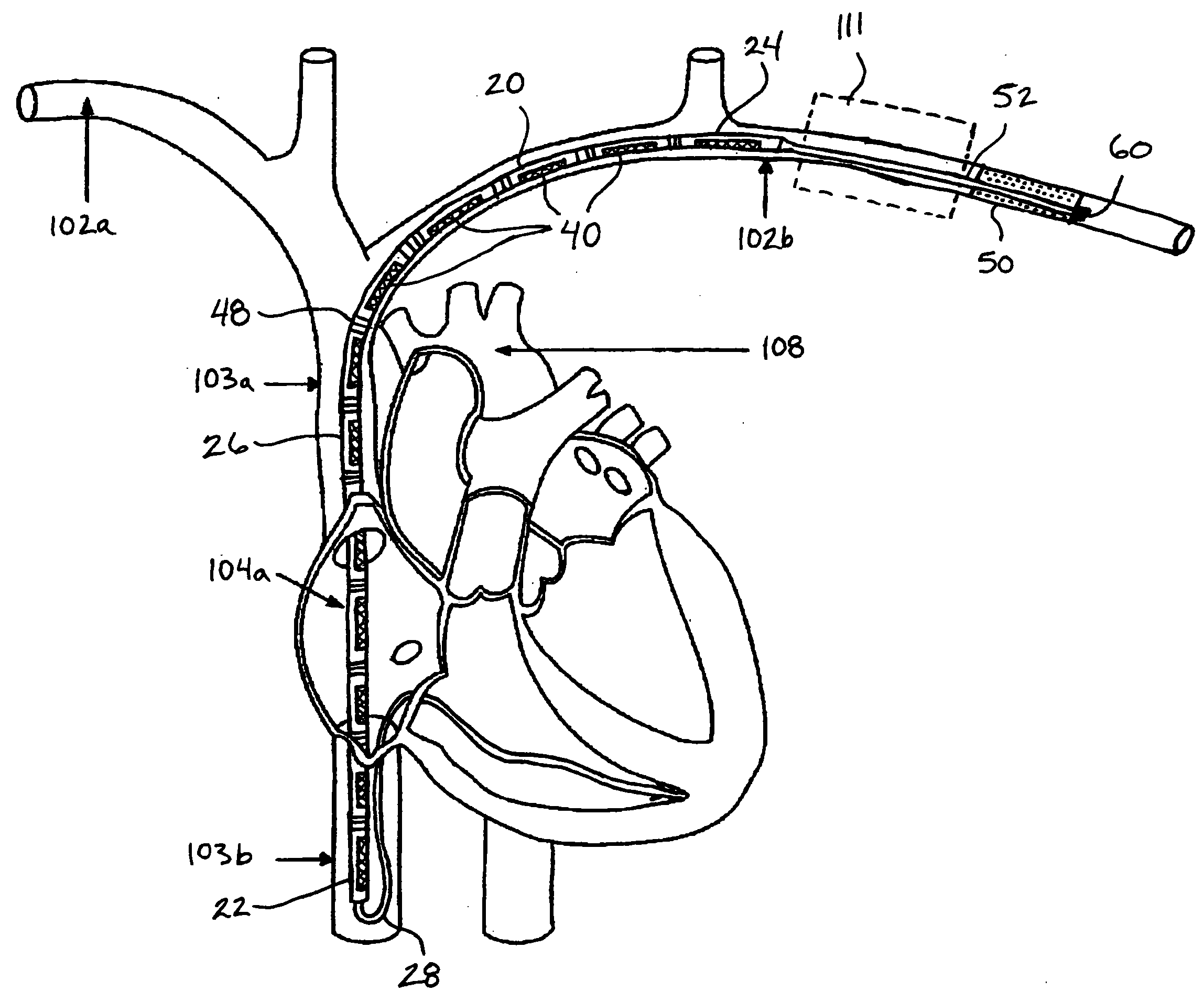 Intravascular implantable device having superior anchoring arrangement