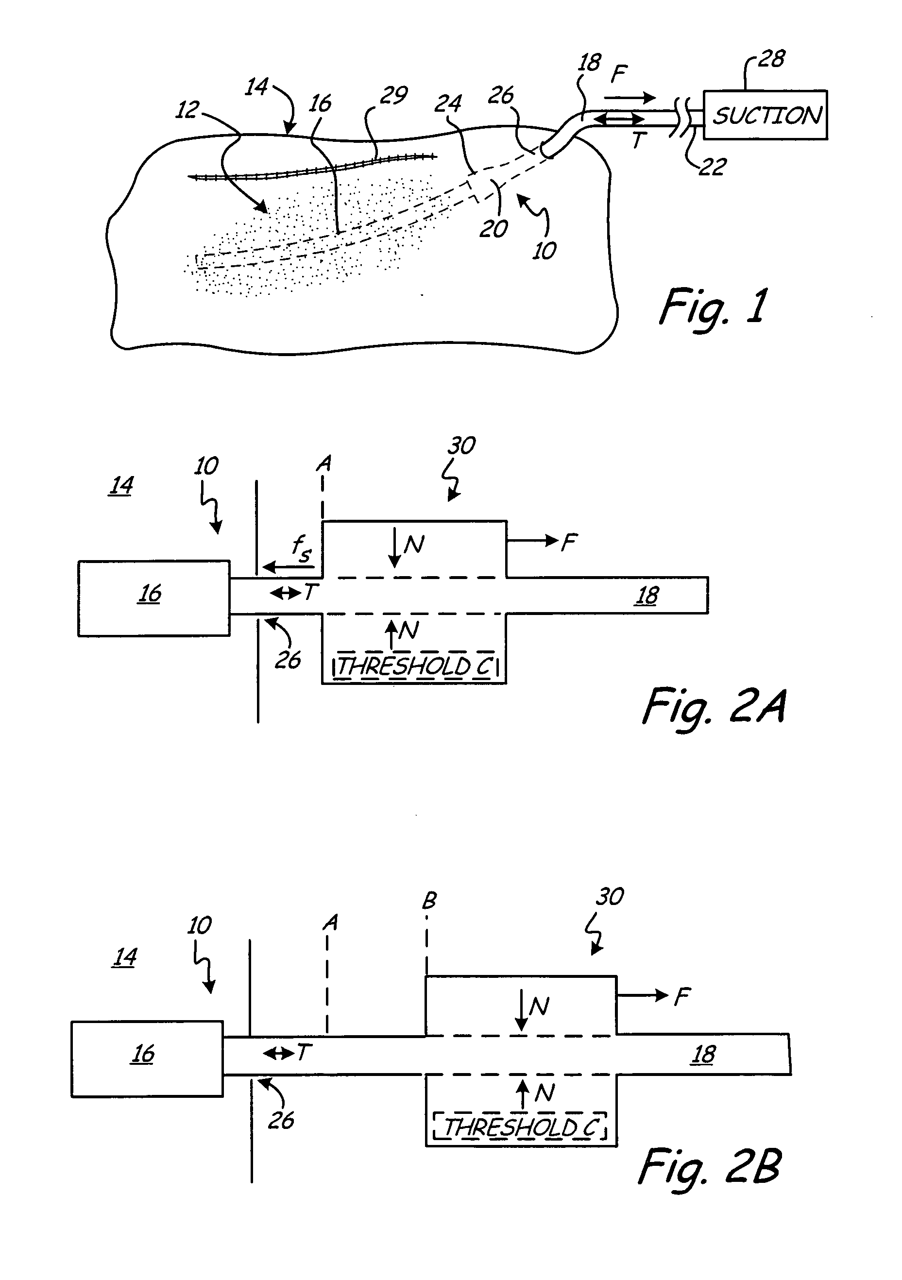 Wound drain removal device