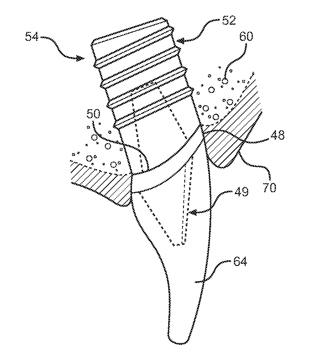 Dental Implant System and Method of Use