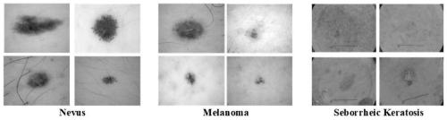 Dermatoscope image enhancement and classification method based on DCNNs and GANs