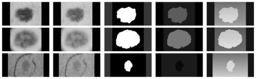 Dermatoscope image enhancement and classification method based on DCNNs and GANs