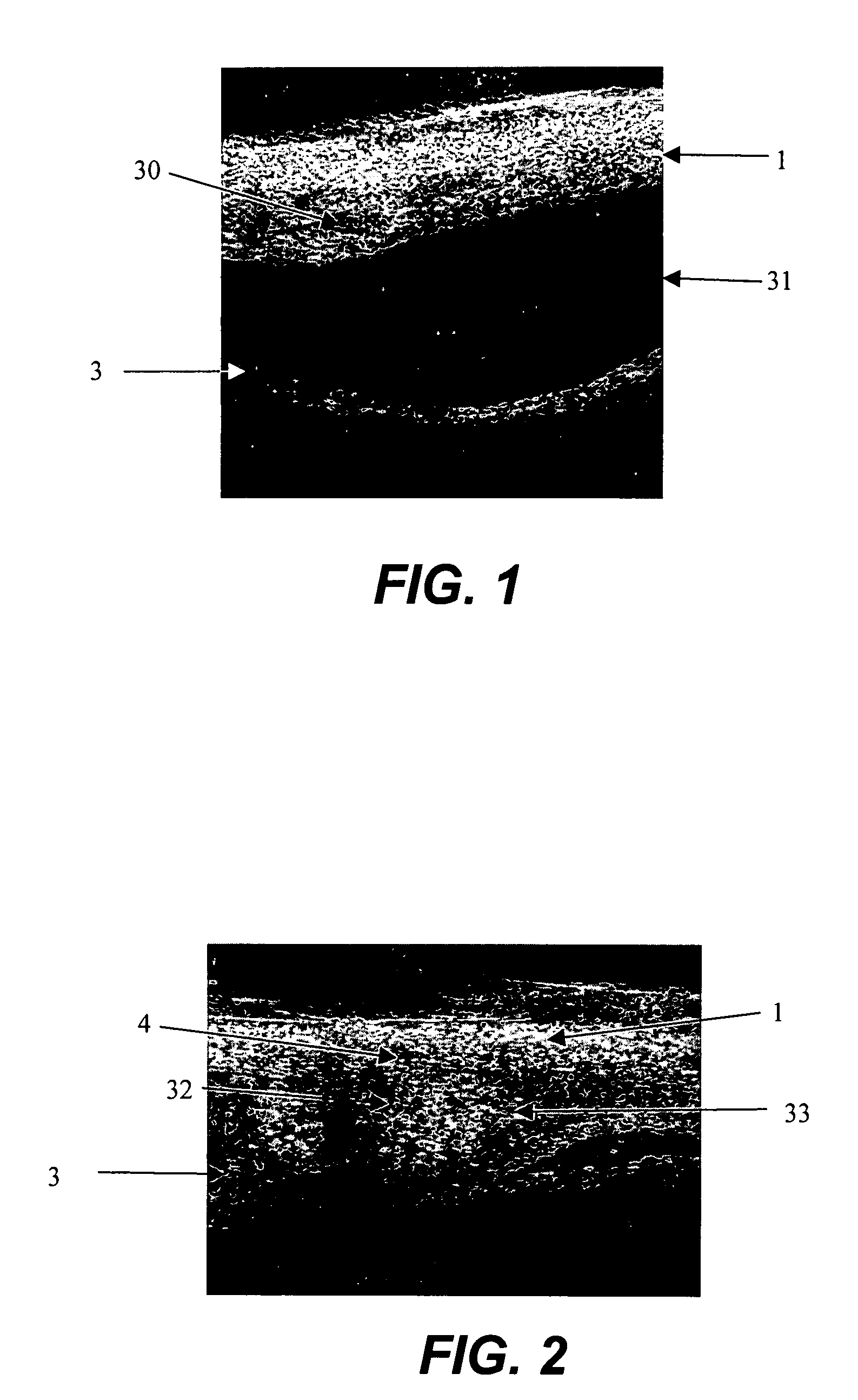 Apparatus and formulations for suprachoroidal drug delivery