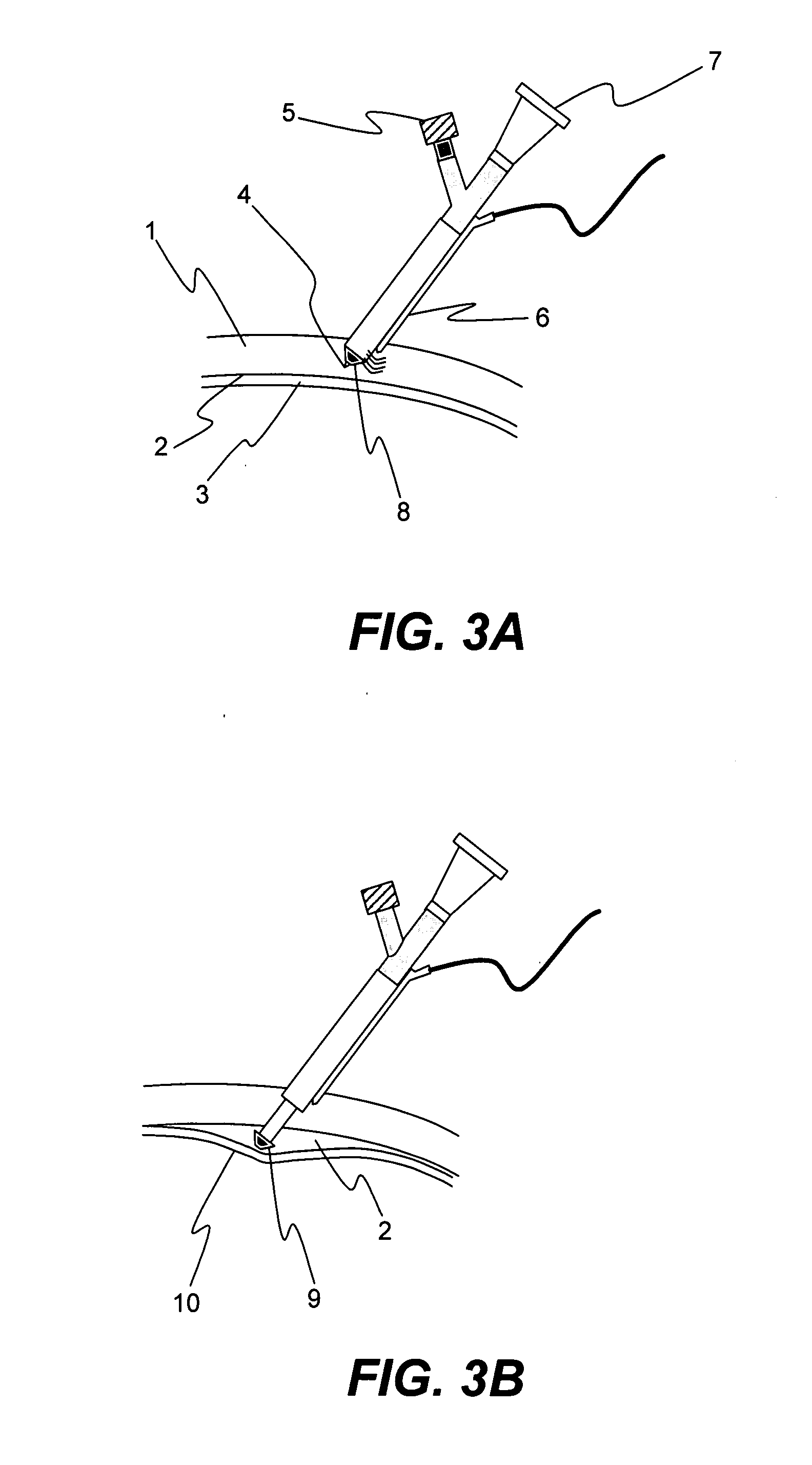 Apparatus and formulations for suprachoroidal drug delivery