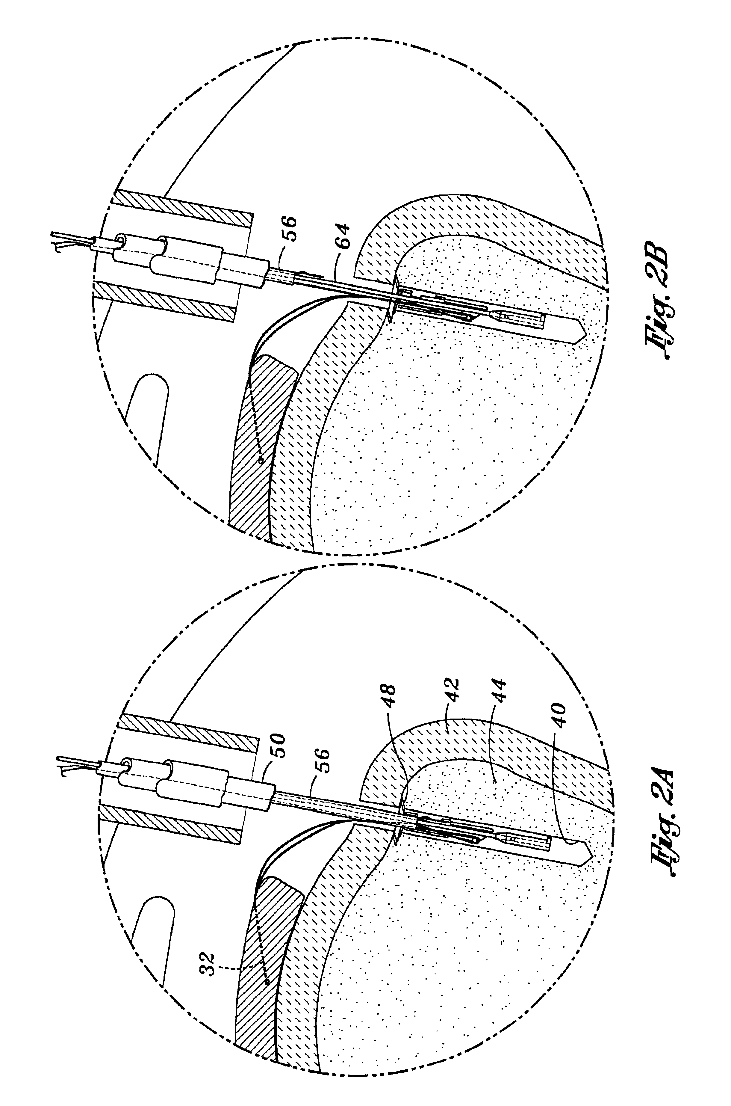 Method and apparatus for attaching connective tissues to bone using a knotless suture anchoring device