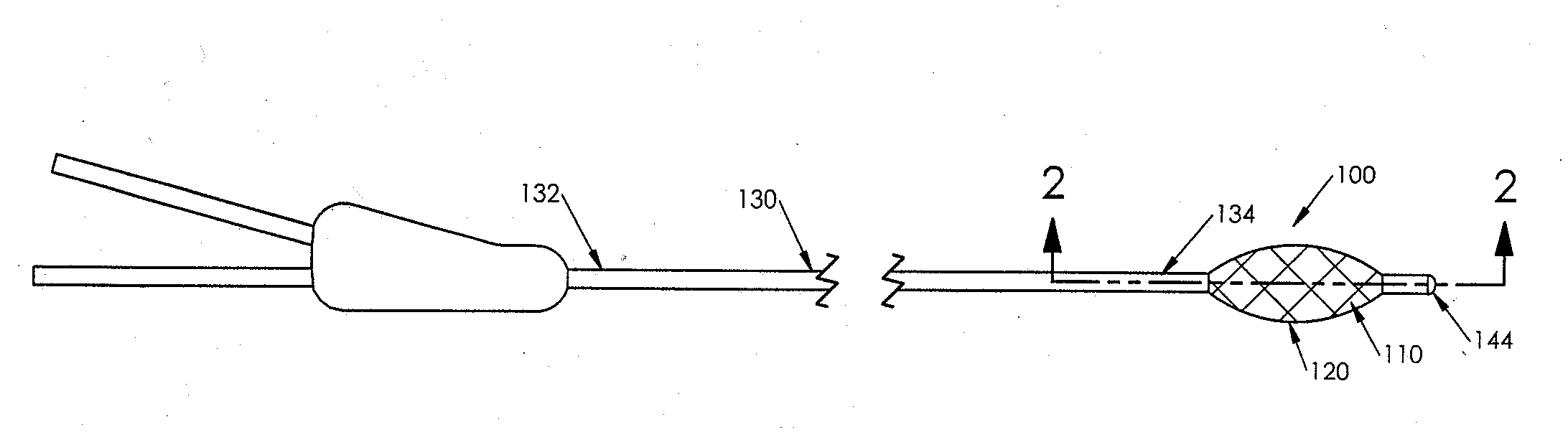 Method for Expanding a Vessel