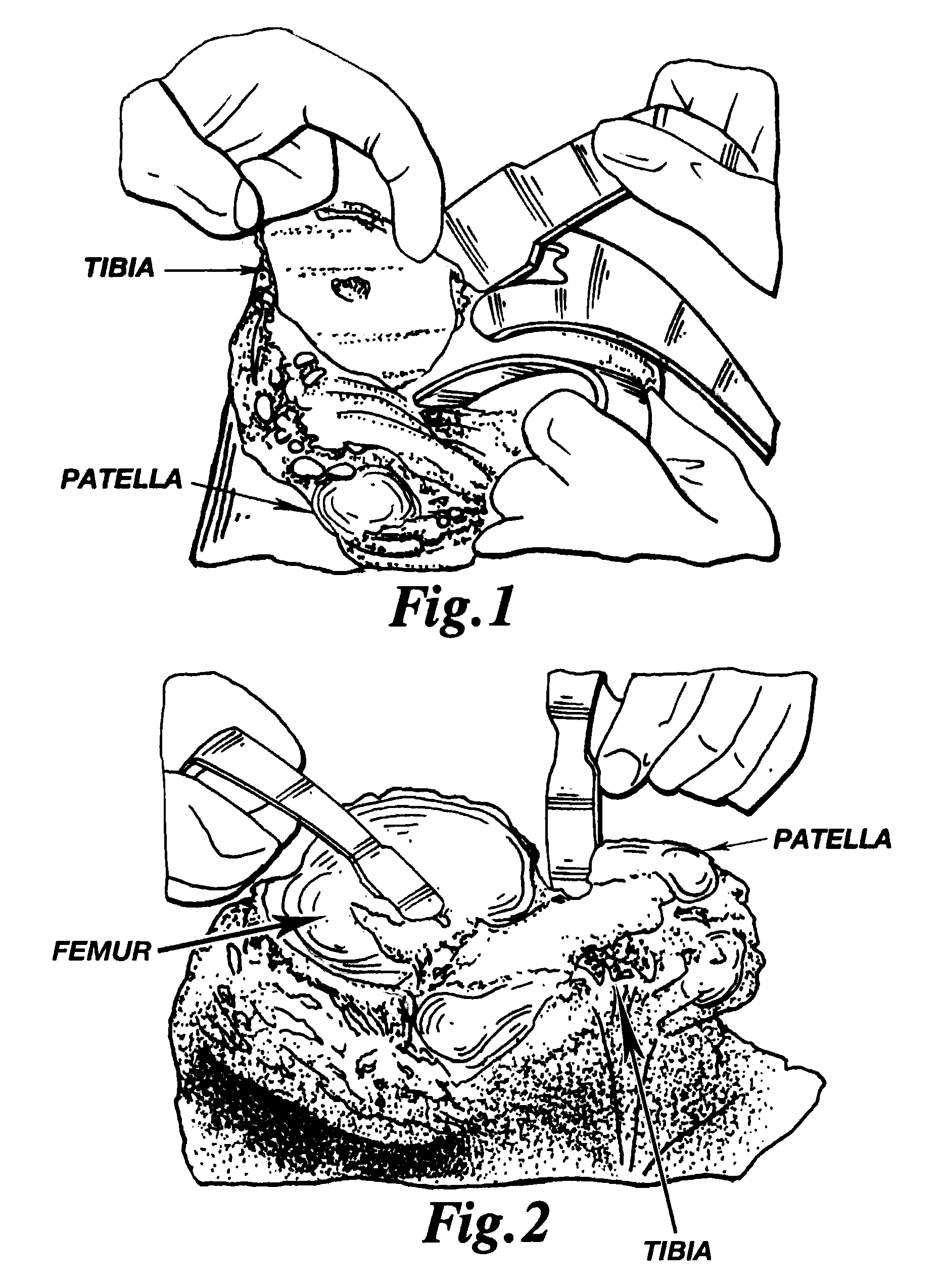 Methods and apparatus for improved cutting tools for resection