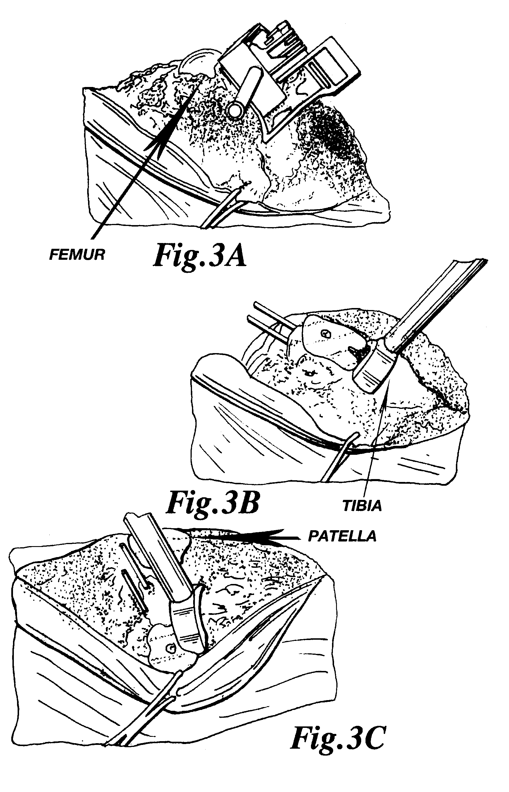 Methods and apparatus for improved cutting tools for resection