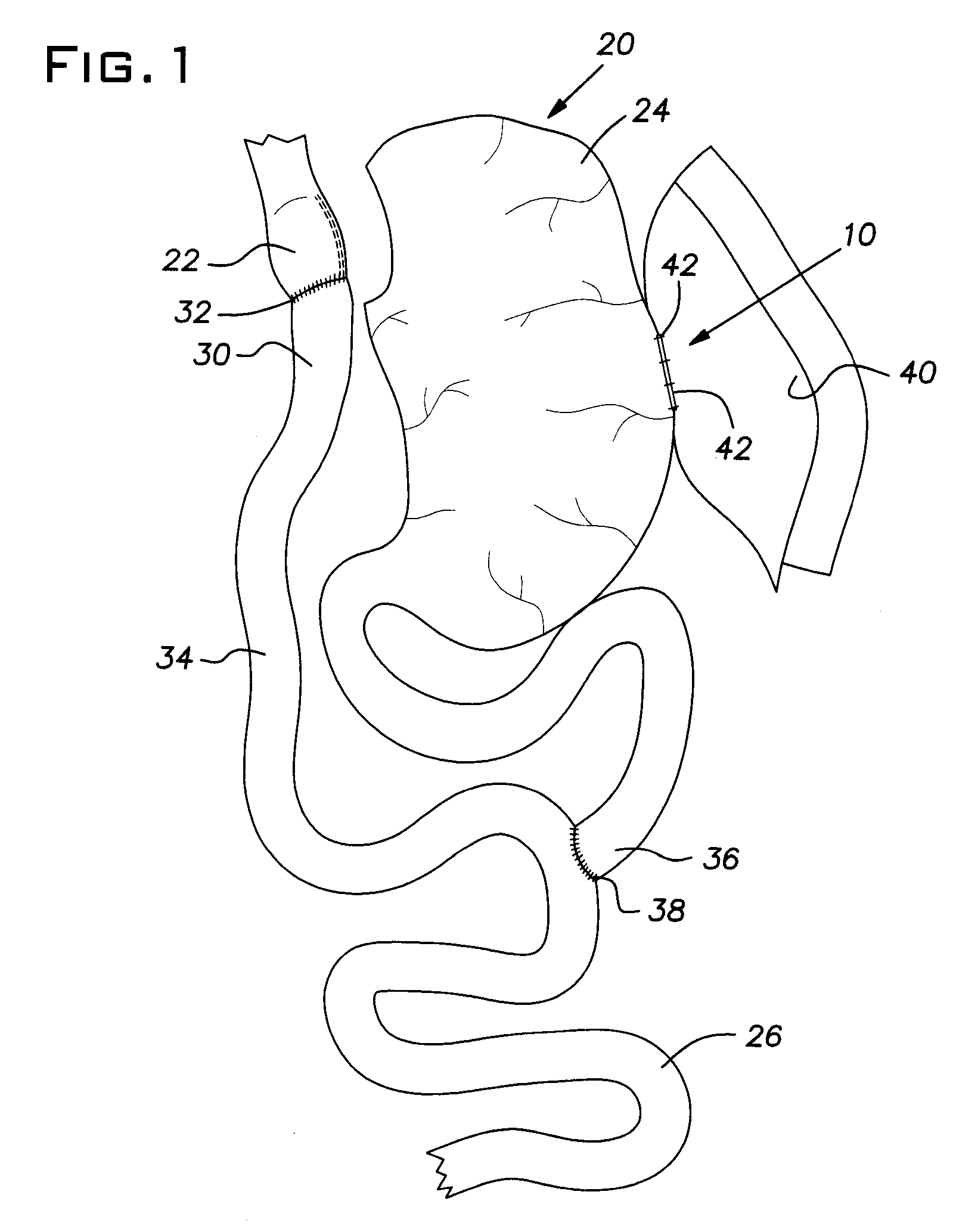 Surgical marker/connector and method of installation