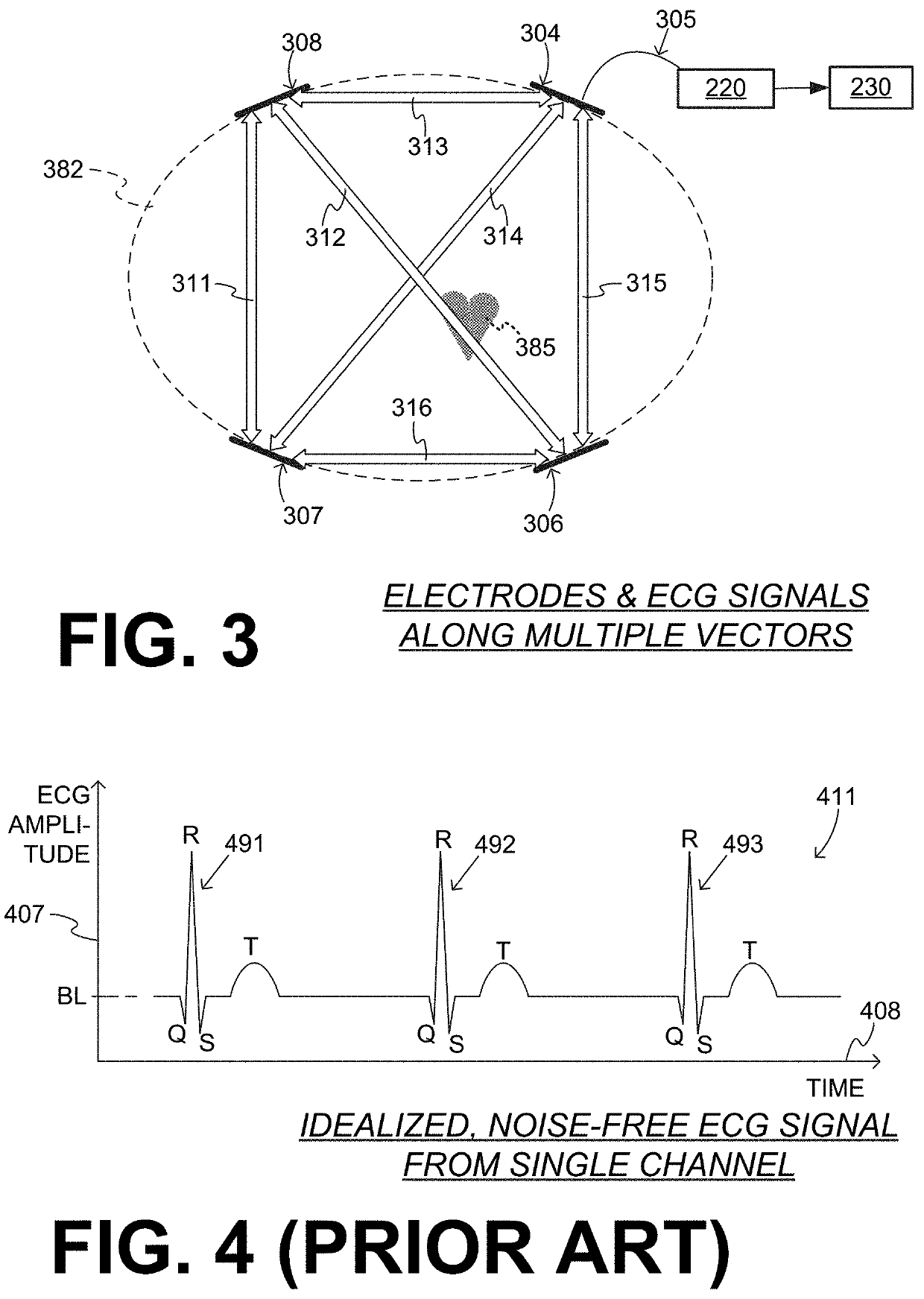 Wearable cardioverter defibrillator (WCD) system evaluating its ECG signals for noise according to tall peak counts