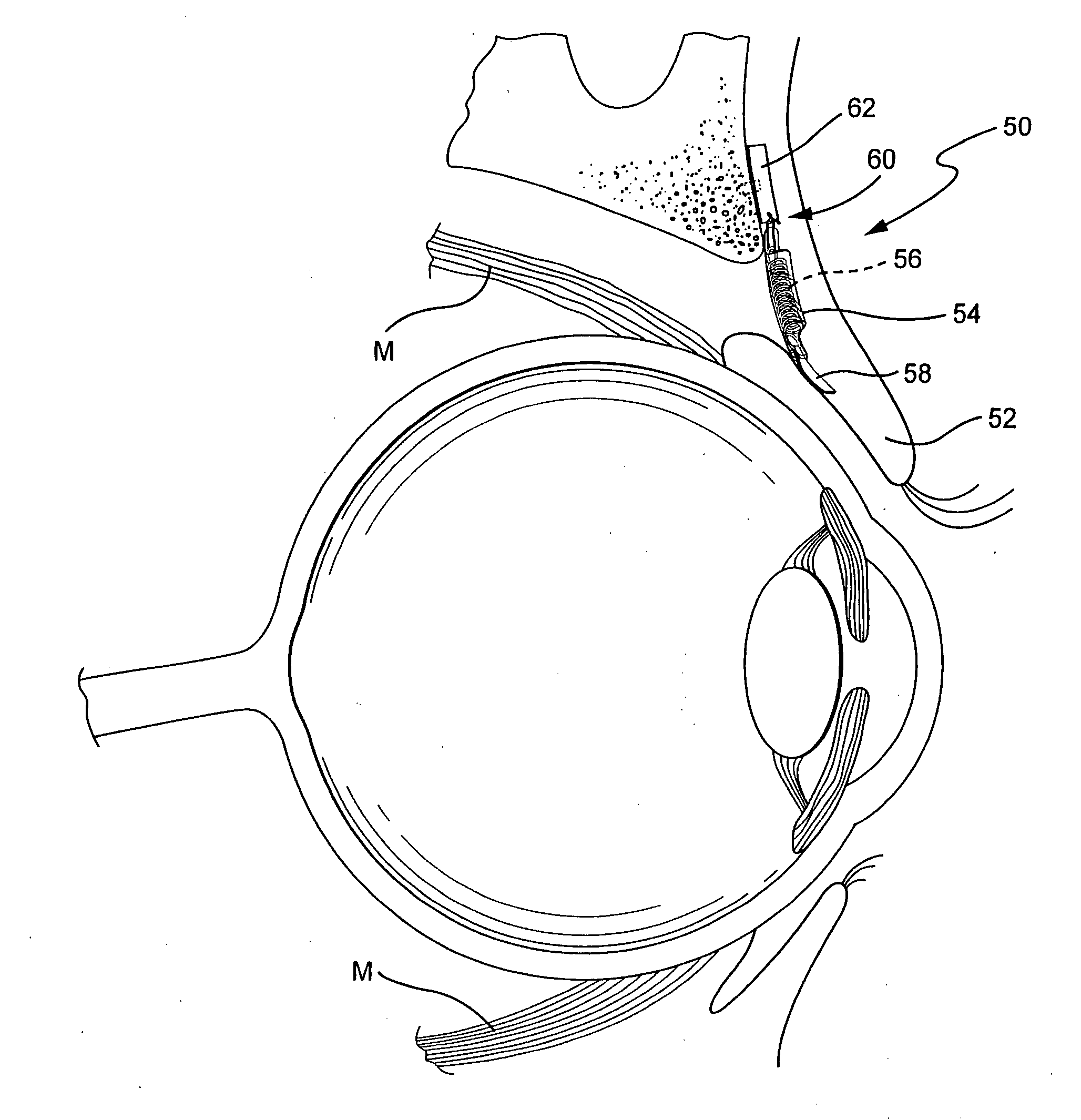 Extraocular muscle prosthesis