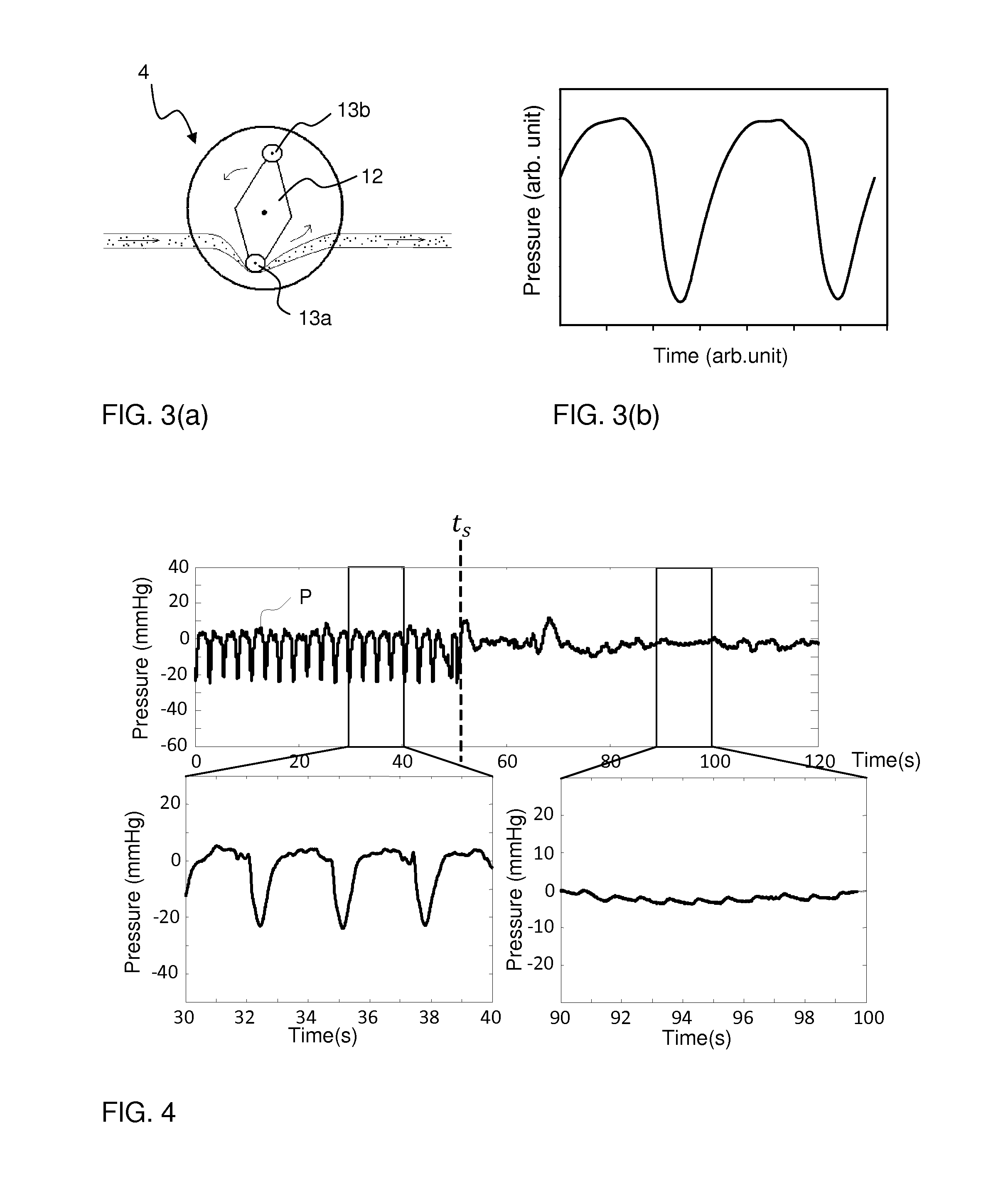 Separation of interference pulses from physiological pulses in a pressure signal